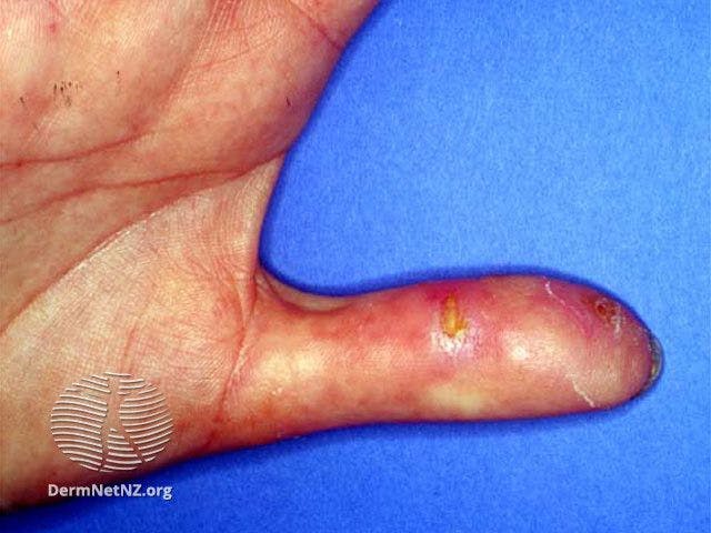 Calcinosis of systemic sclerosis

Image courtesy of DermNet