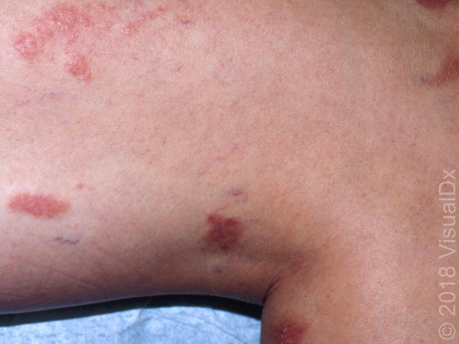 Image IQ: Burning skin lesions after a walk