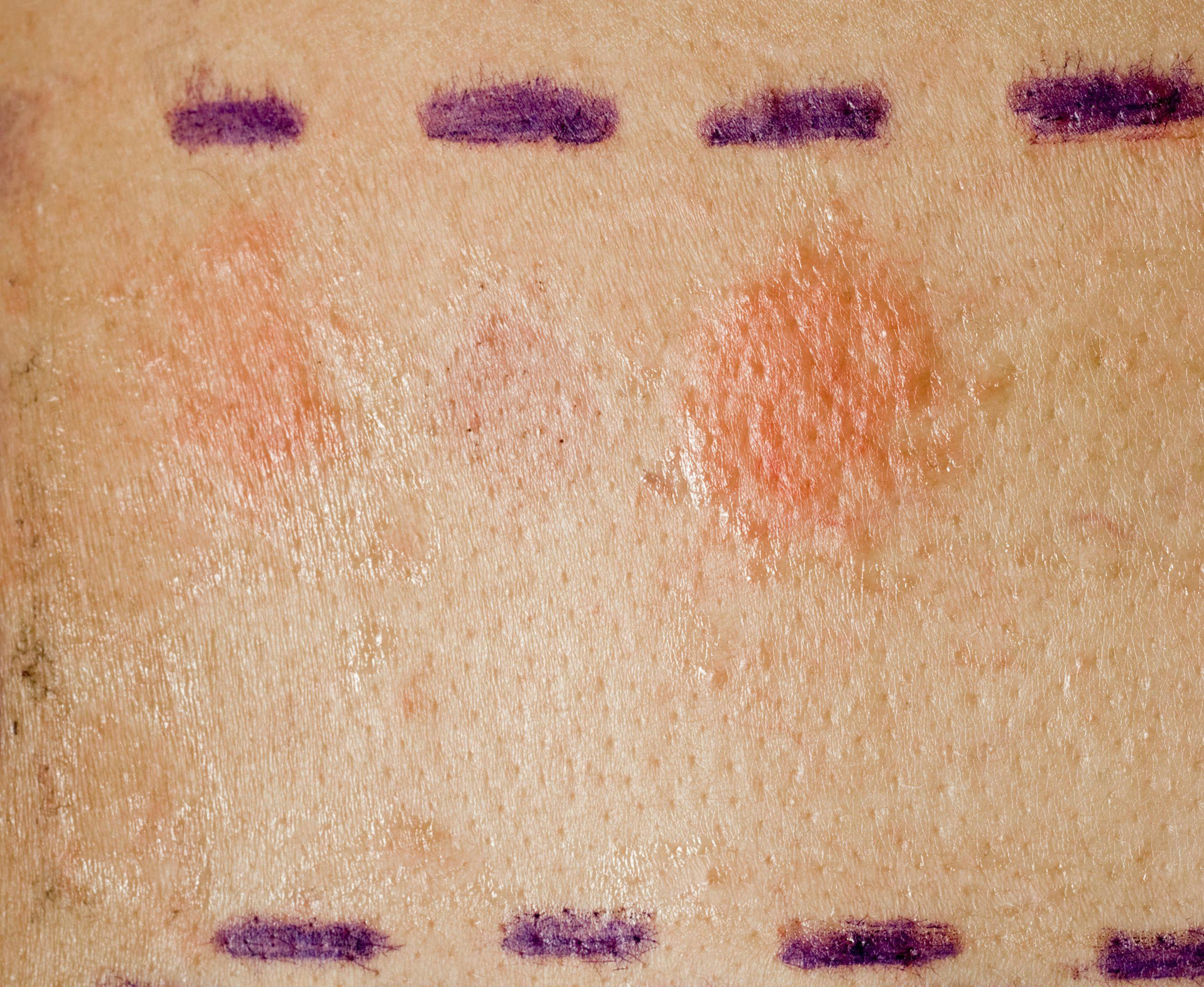  Patch Testing for Contact Dermatitis and Biomedical Devices Allergens   
