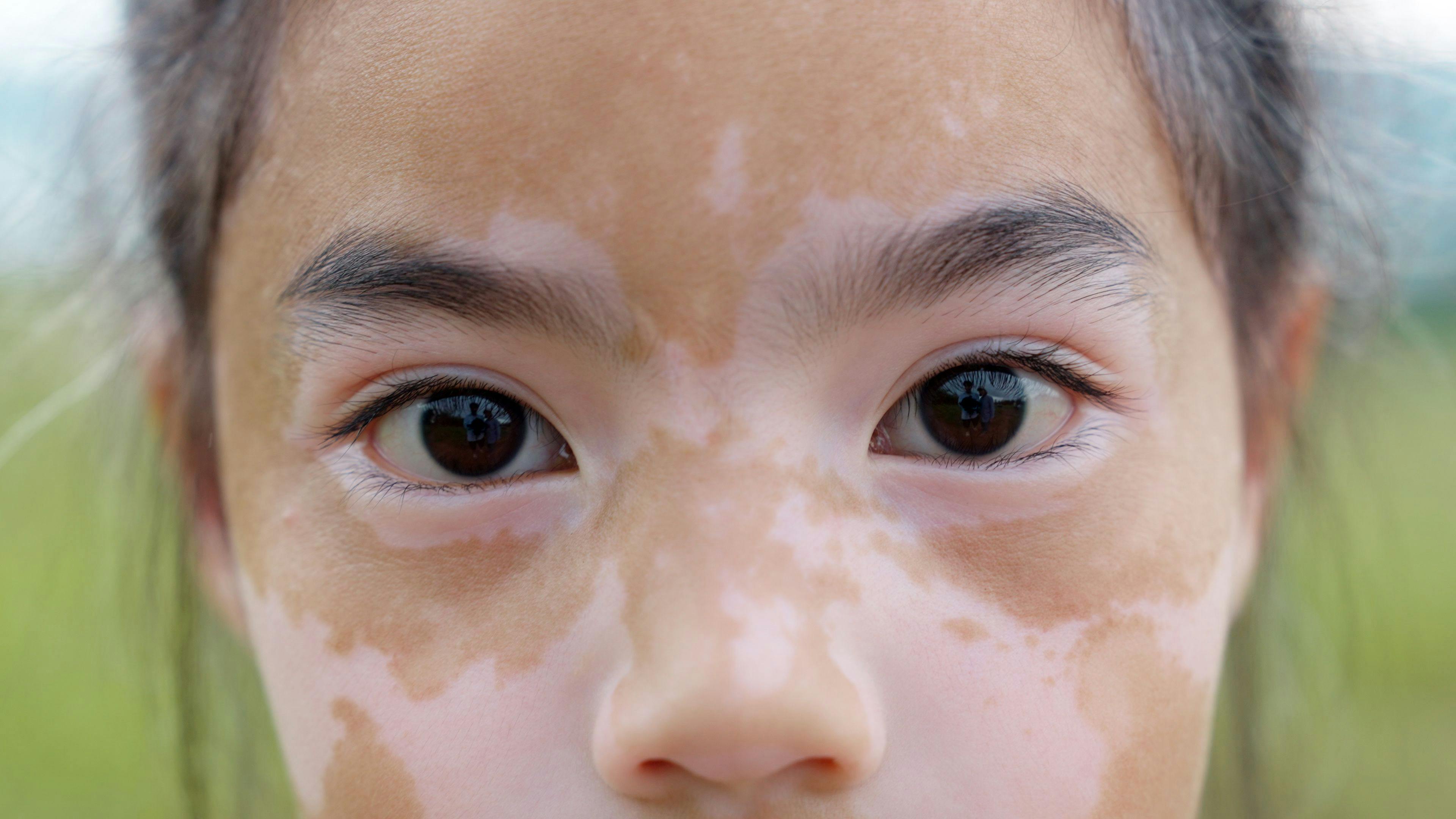 Given Prevalence, Study Underscores Need for Education Surrounding Pediatric Dermatoses in Patients With Skin of Color