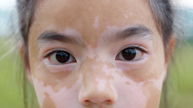 Given Prevalence, Study Underscores Need for Education Surrounding Pediatric Dermatoses in Patients With Skin of Color