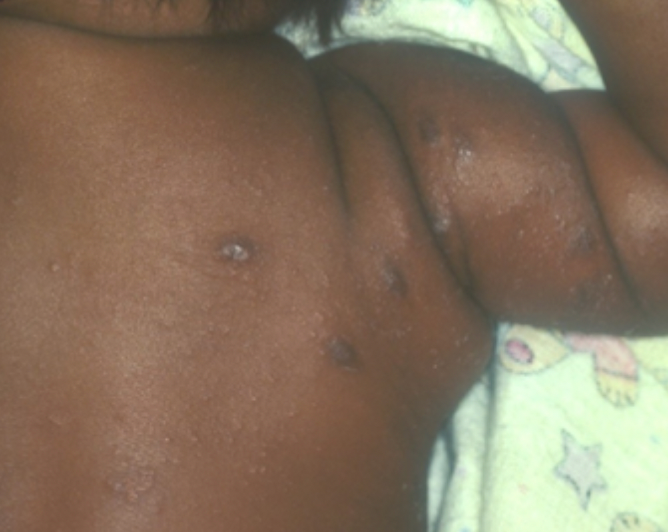 Infant with recurrent eczematous rash initially treated with topical emollients and steroids showing significant improvement following diagnosis and treatment of scabies | Image Credit: Bernard Cohen, MD