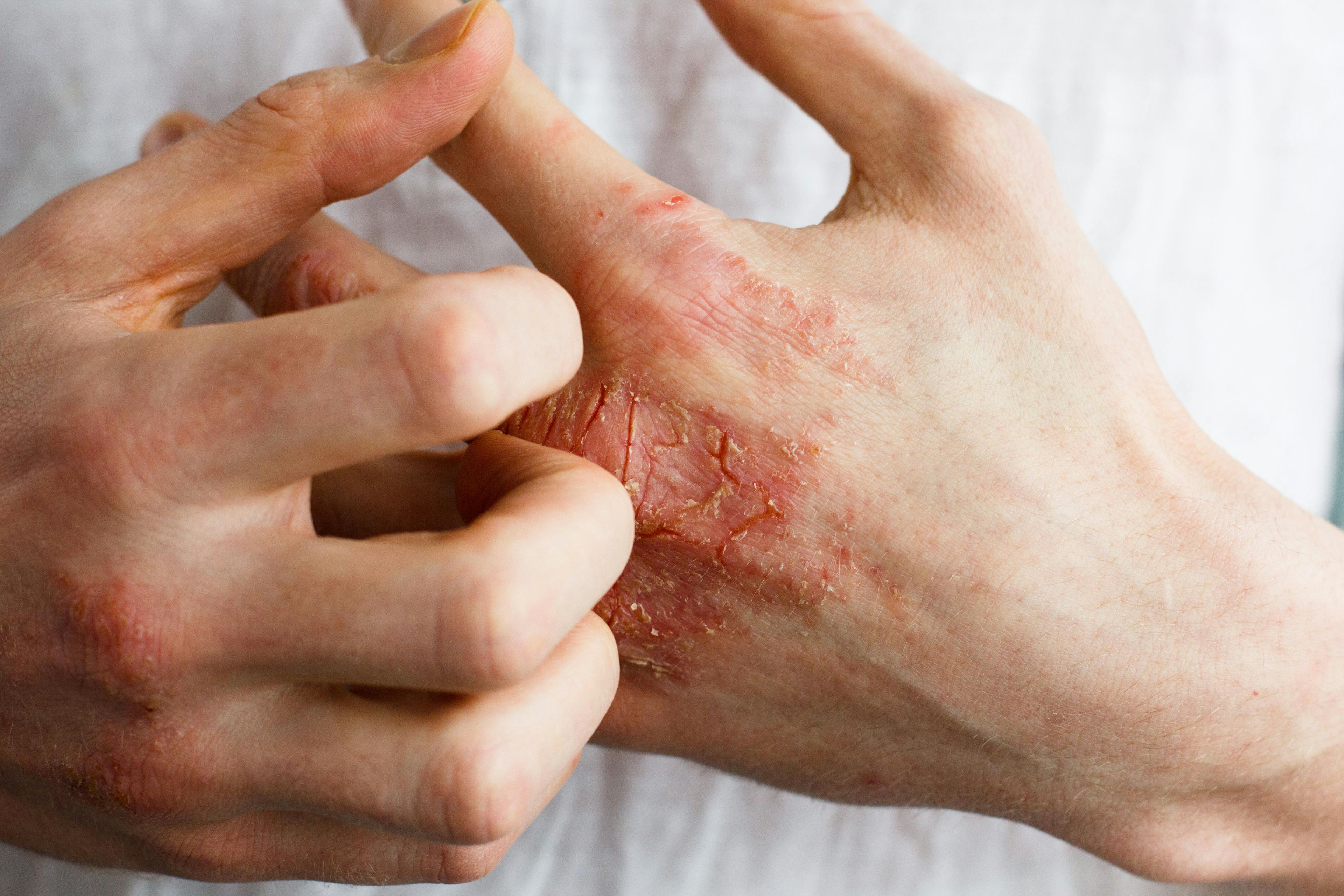 Treating Dermatitis in Healthcare Workers