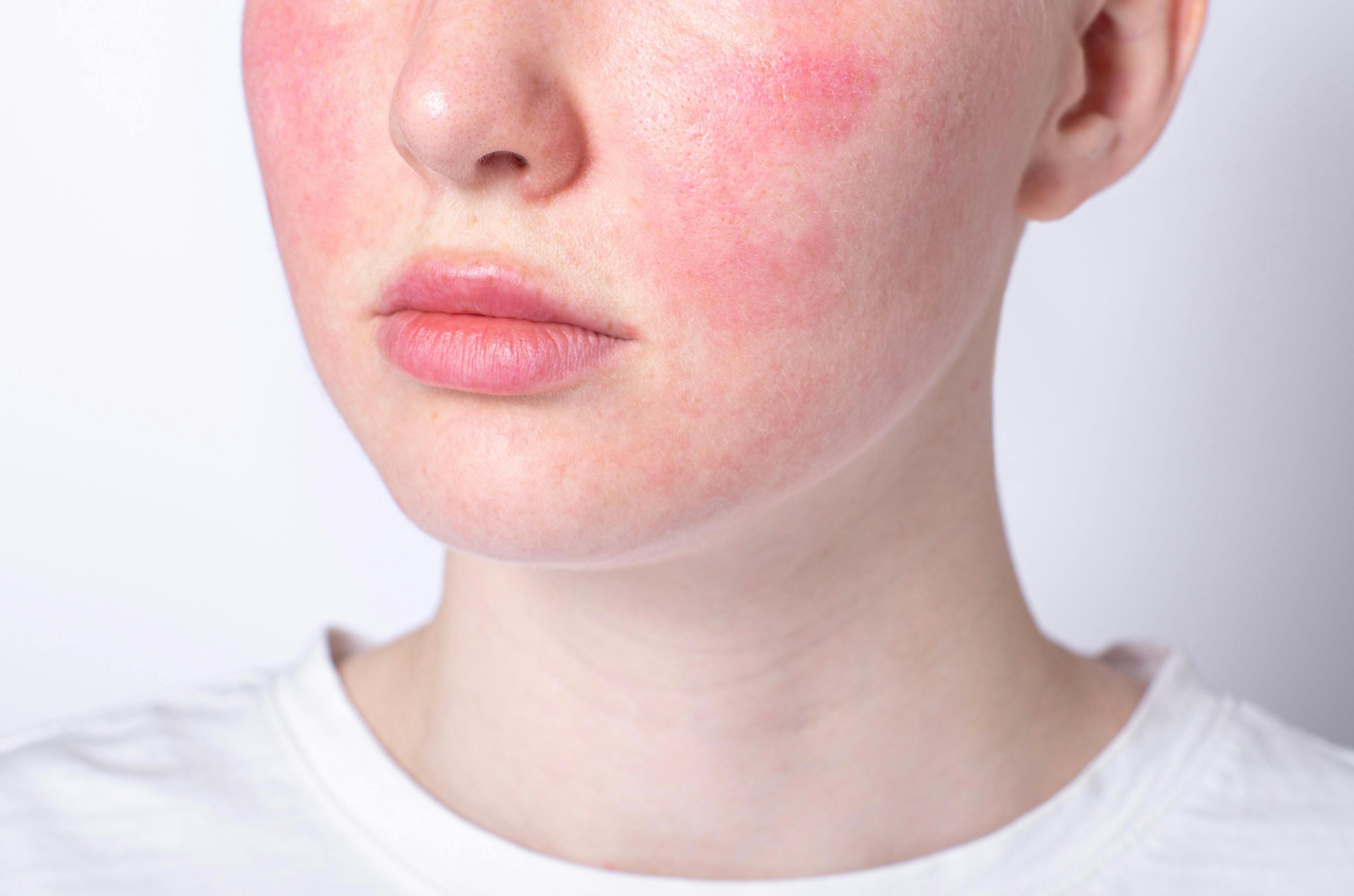 Review Finds Topical Erythromycin, Azithromycin, and Metronidazole Most Common Treatments for Pediatric Rosacea