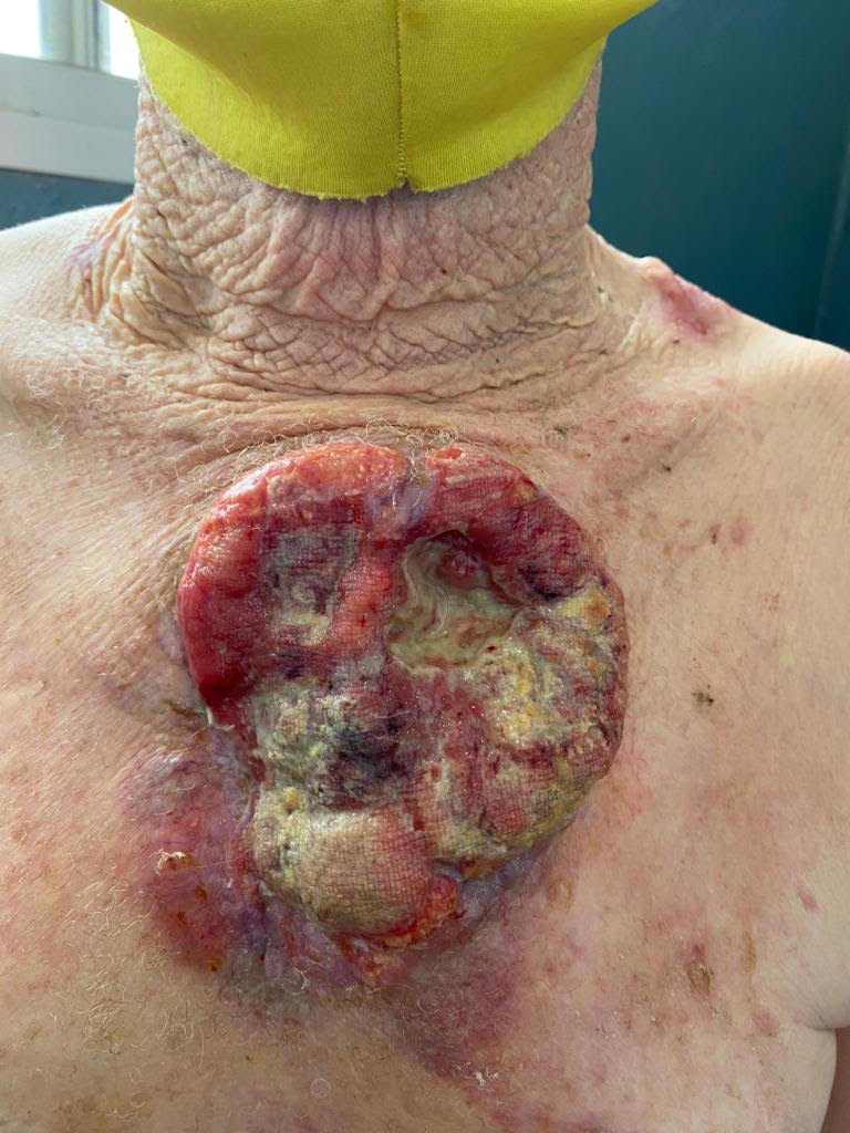 Large invasive squamous cell carcinoma on the chest and left shoulder of a patient with albinism. Photo courtesy: Khachemoune was provided with this photo by colleague Ibrahima Traore, MD, PgDip, MSc, leading dermatologist in Conakry, Guinea.