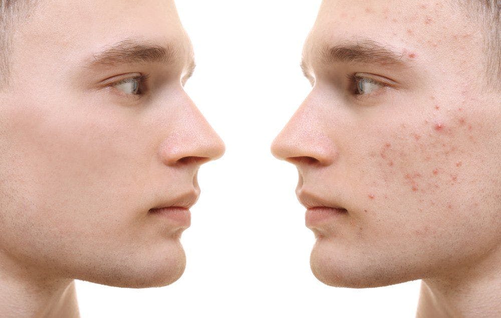 The science behind acne scarring 