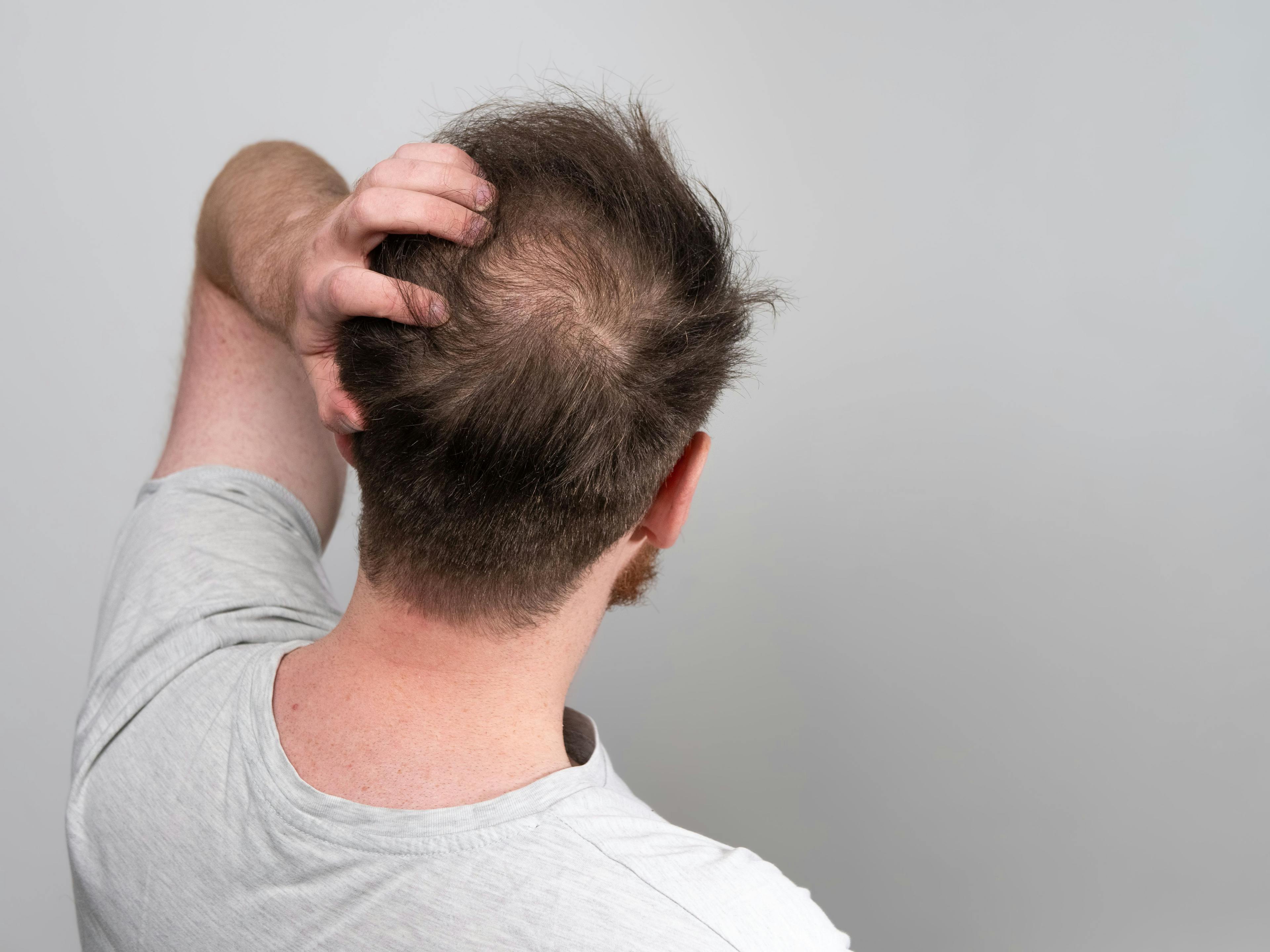 Smoking Cigarettes Associated With Higher Odds of Disease Progression in Male Pattern Hair Loss