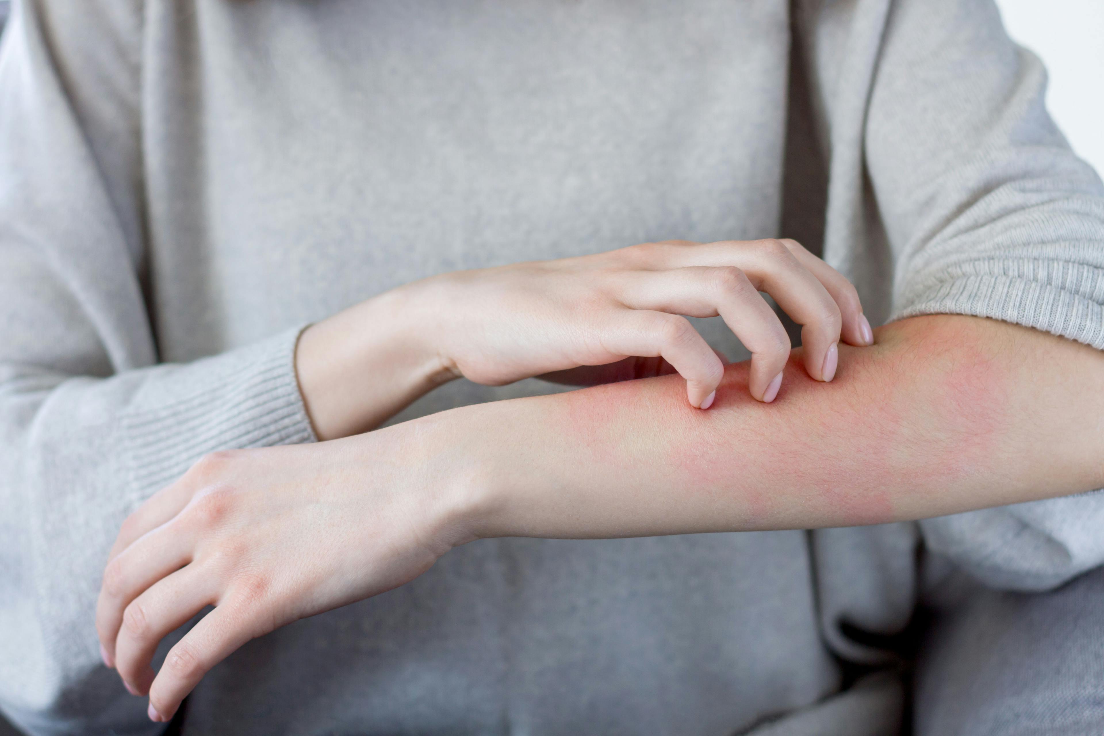 Treating Atopic Dermatitis in the Winter: Moisturizers, Ointments and Creams