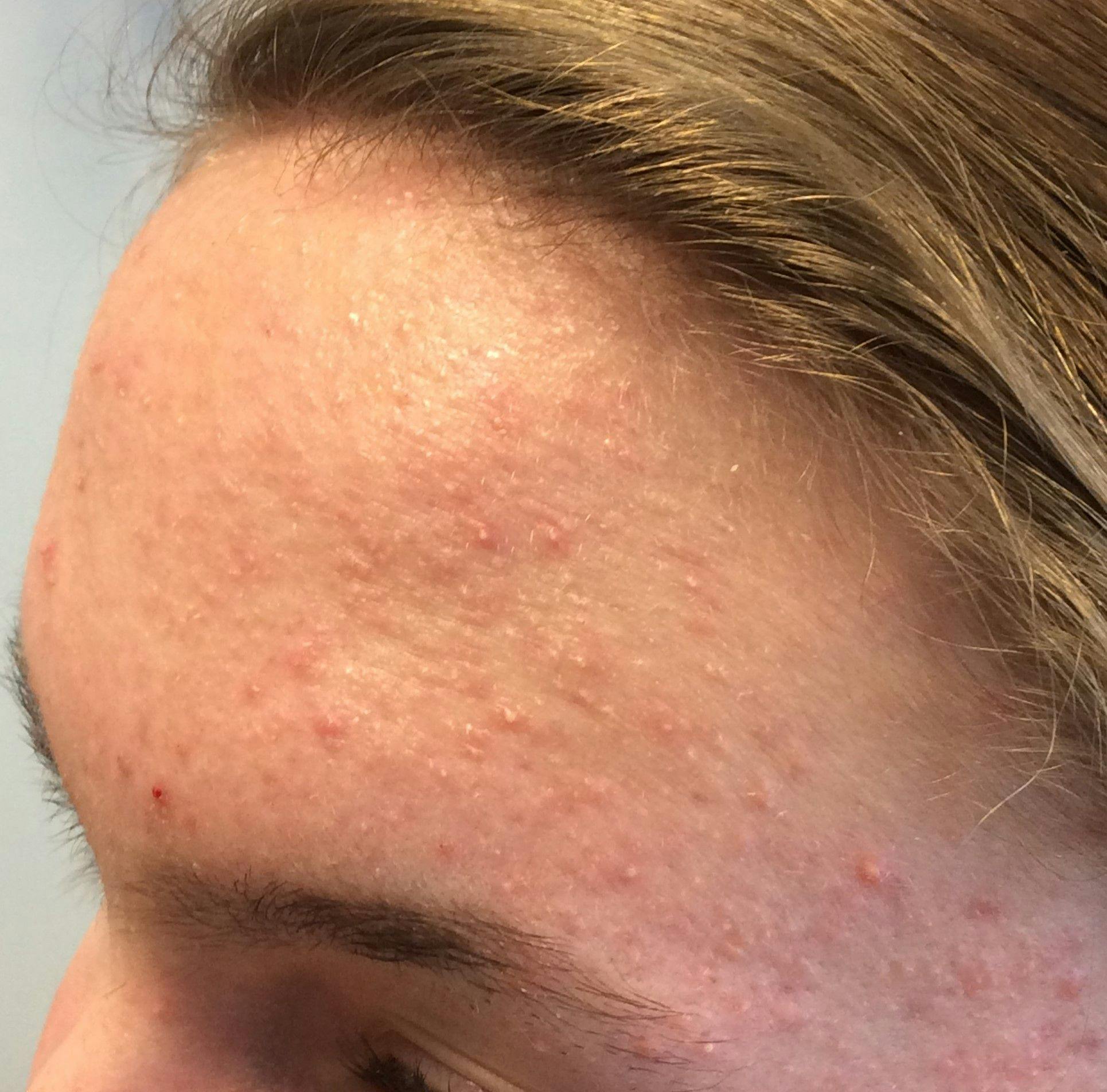 Is it acne or Pityrosporum folliculitis?