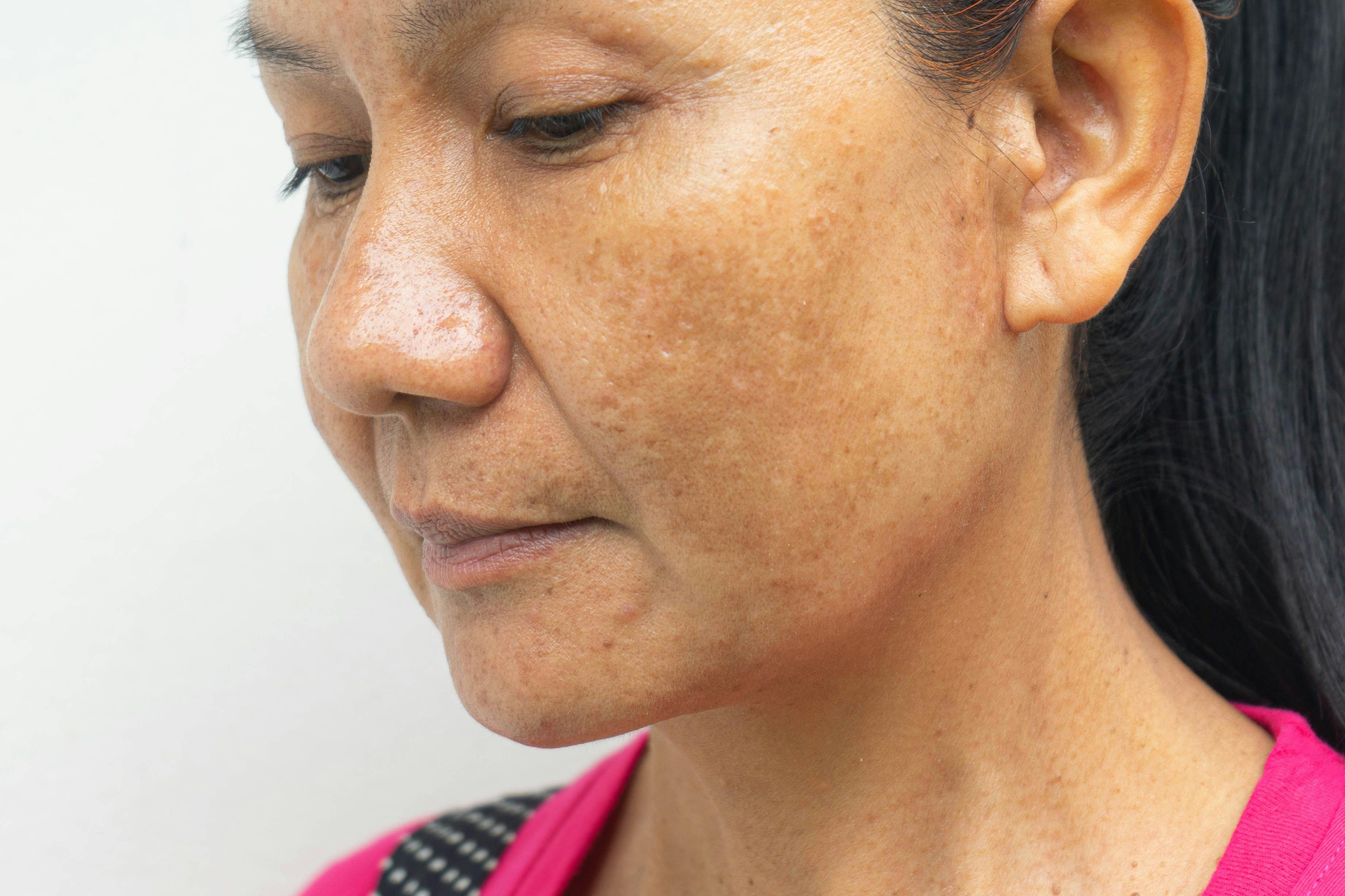 QUIZ: Which of the Following Conditions is NOT a Mimicker of Melasma? 