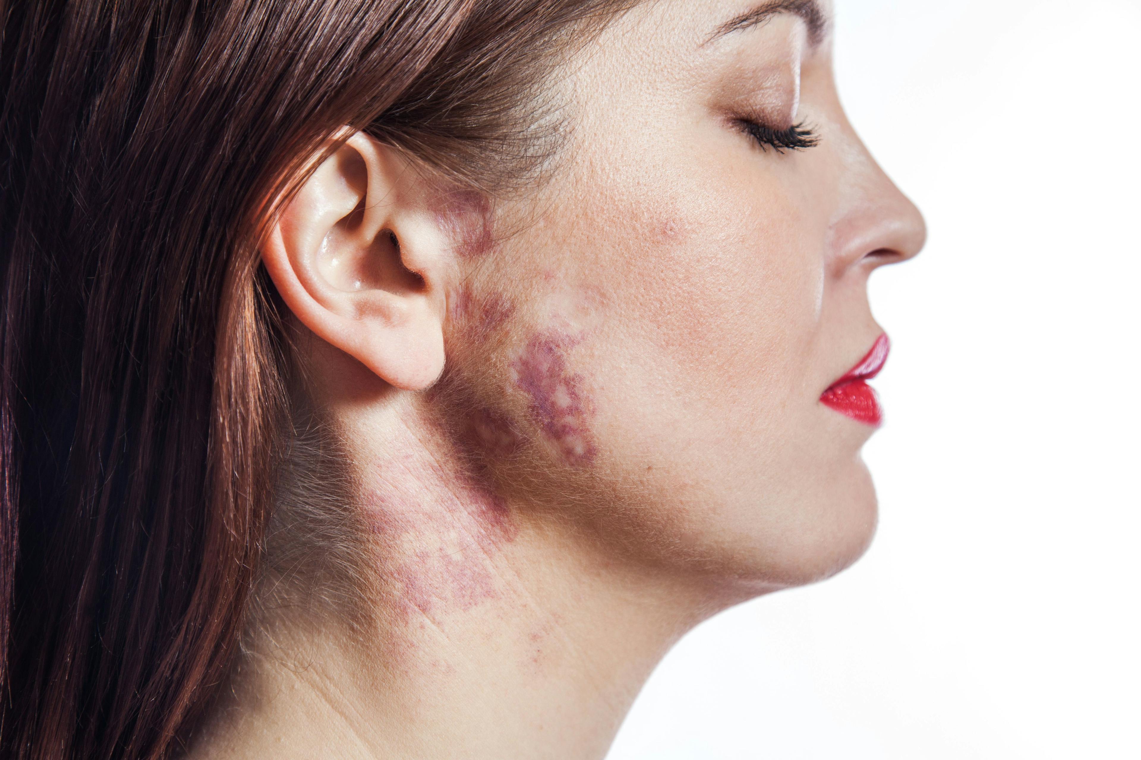 Fewer Treatments Necessary for Port Wine Stain Removal With Larger Spot Laser