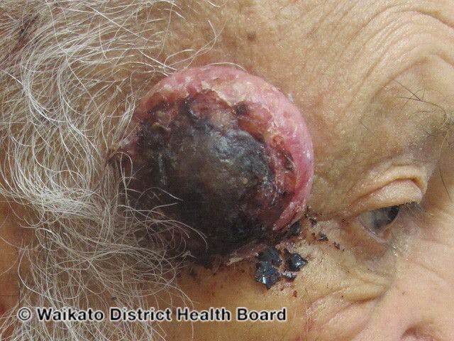High-risk cutaneous squamous cell carcinoma

Image courtesy of the Waikato District Health Board and DermNetZ