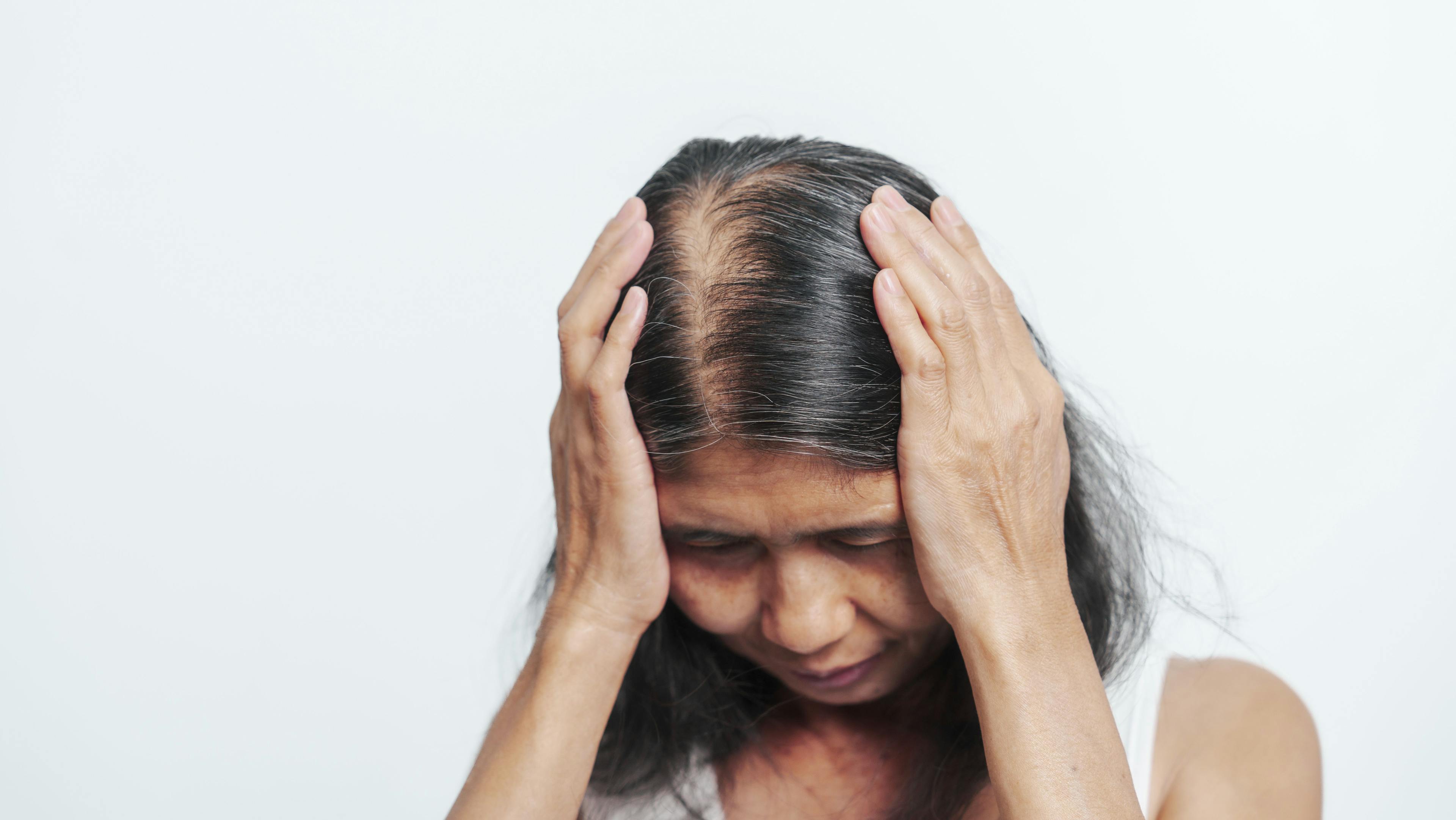 Clinical Trial Disparities, Alopecia Areata Misdiagnoses Prevalent Among Non-White Patients