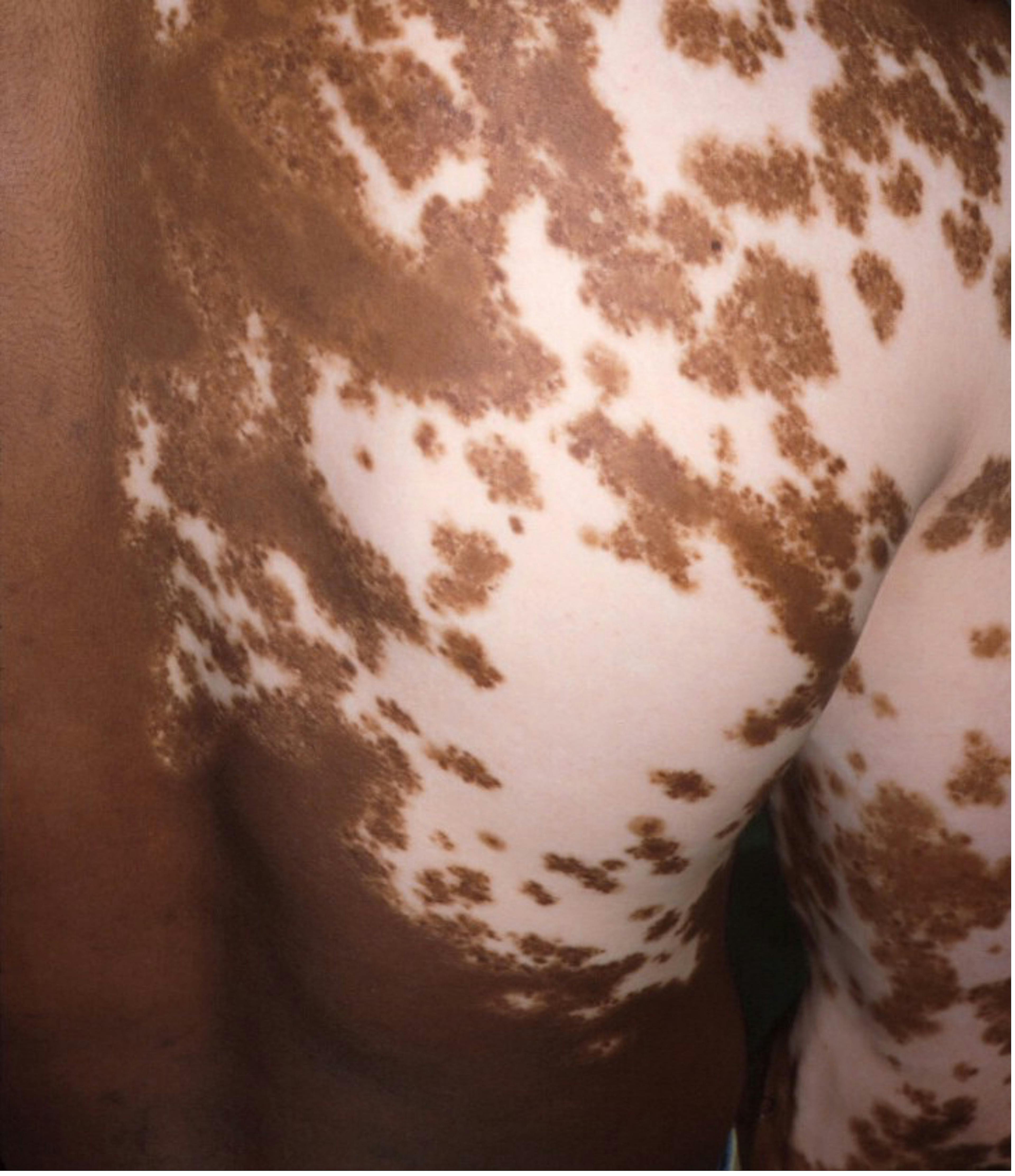 A Case of Vitiligo in an 11-Year-Old Male