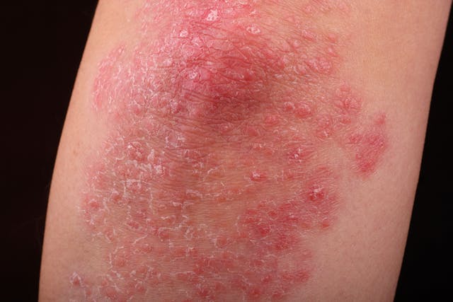 New Study Uncovers Cells and Pathways Driving Psoriasis Inflammation and Severity