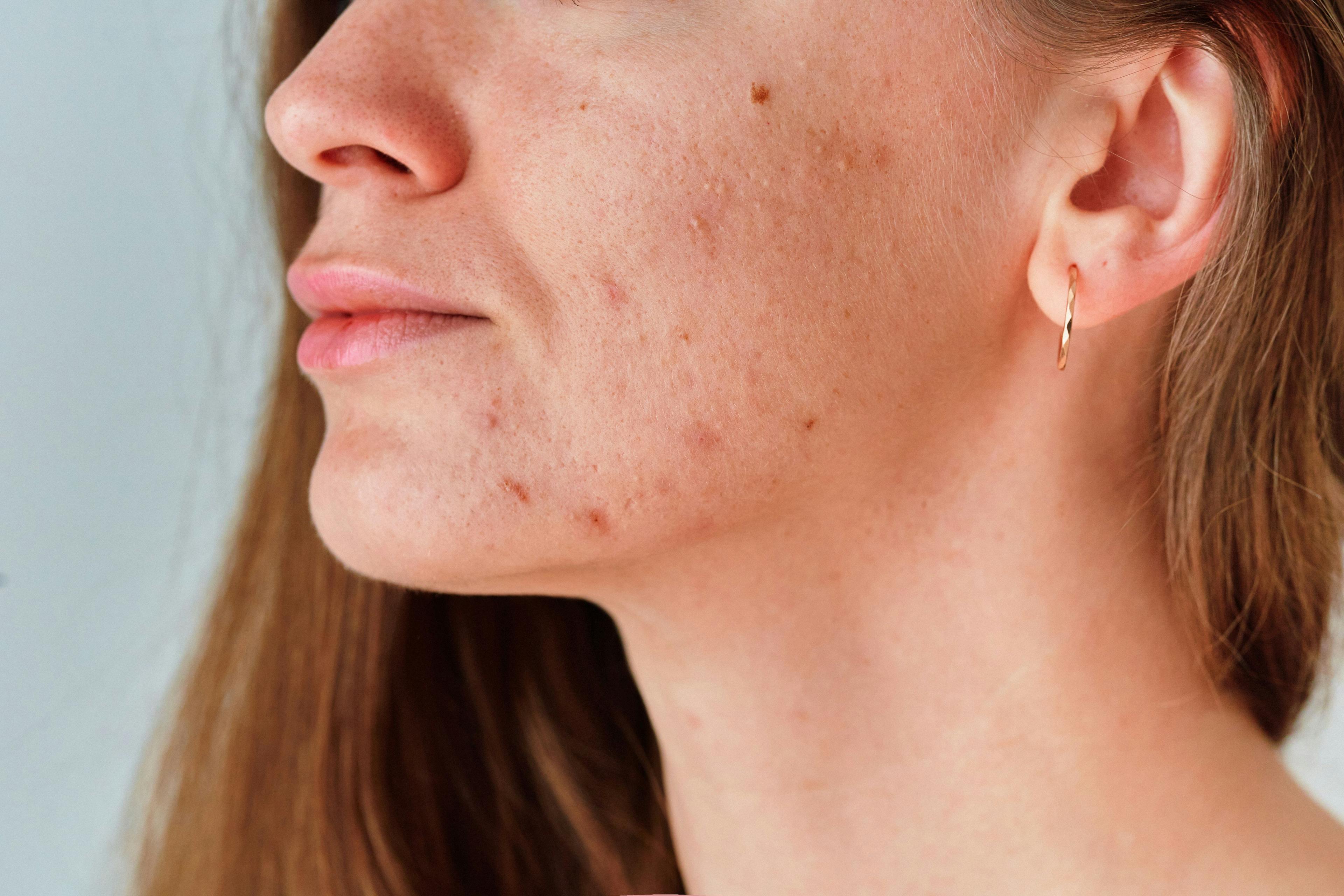 Individualized Treatment Considerations for Adult Women With Acne