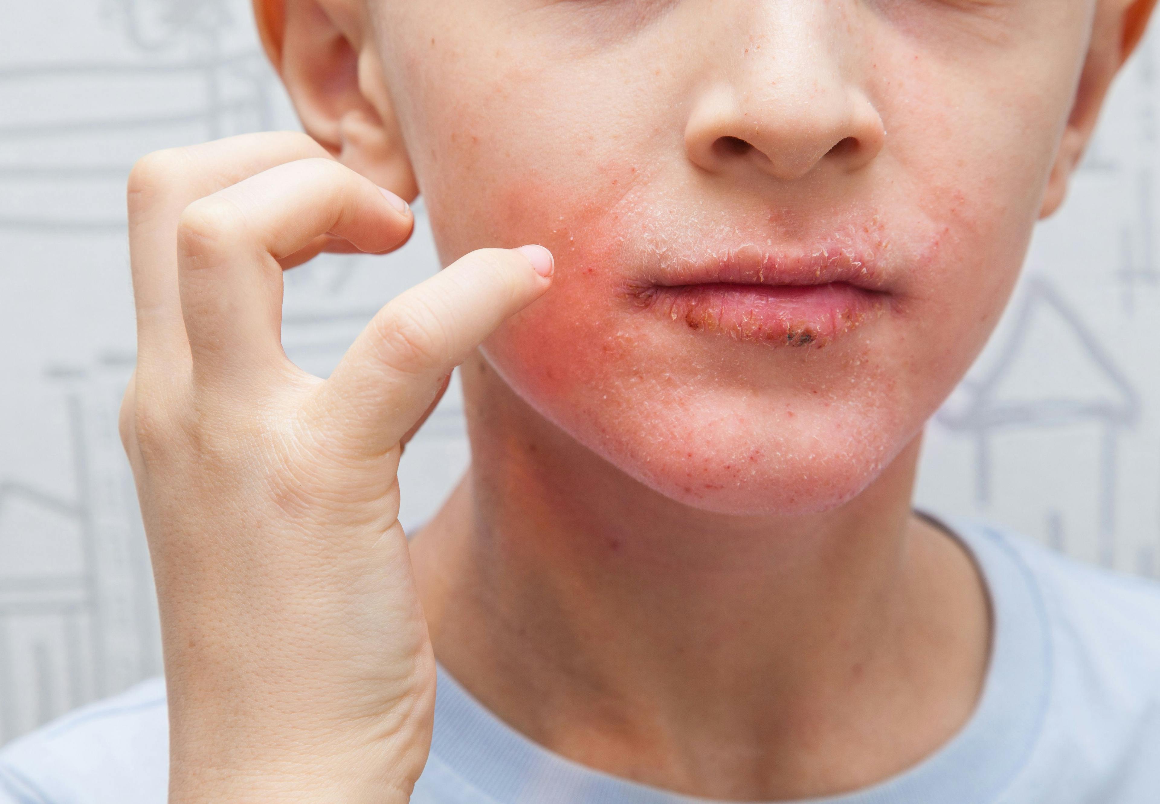 atopic dermatitis in children