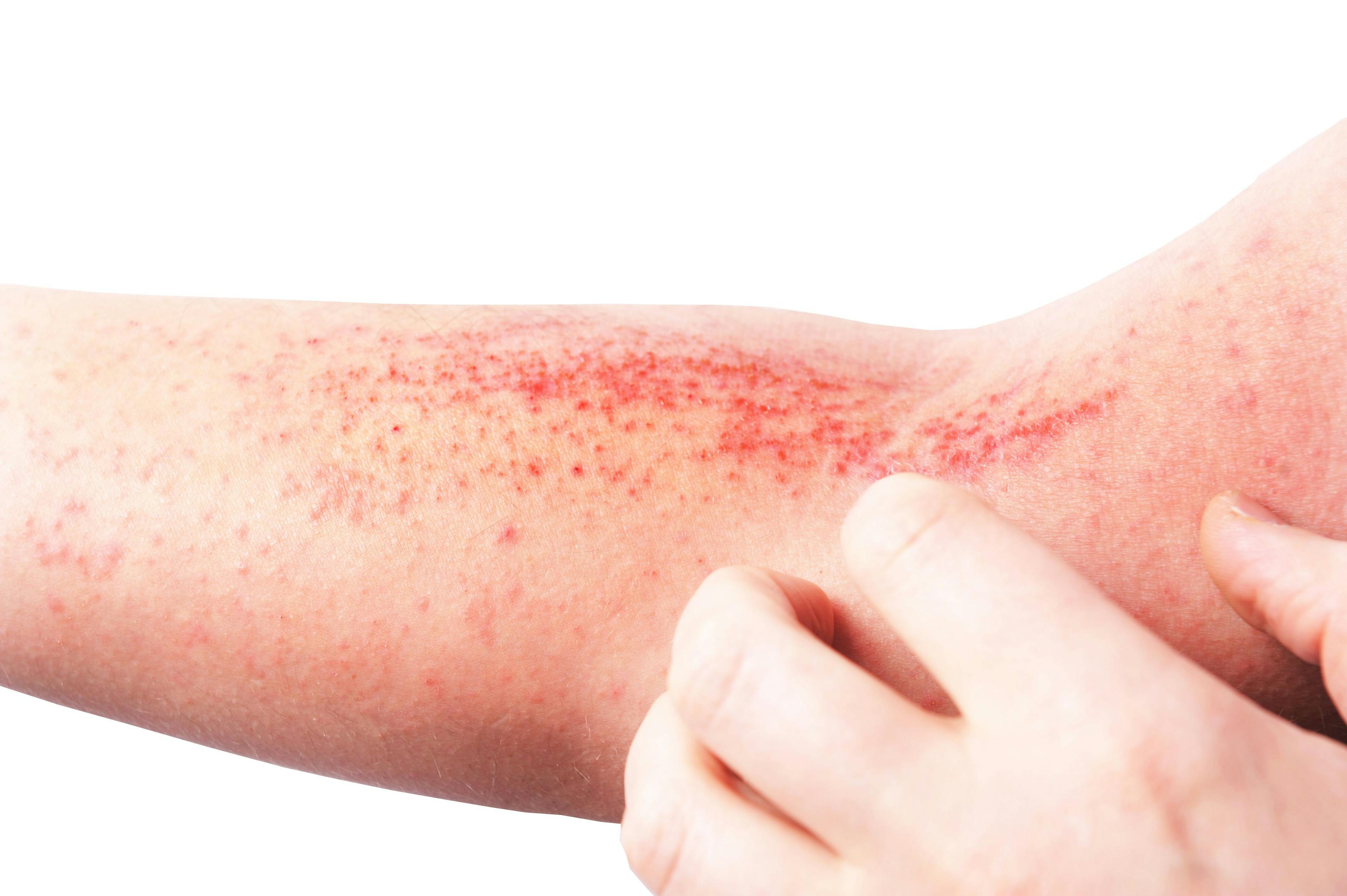New, Updated Guidelines for Managing Atopic Dermatitis 