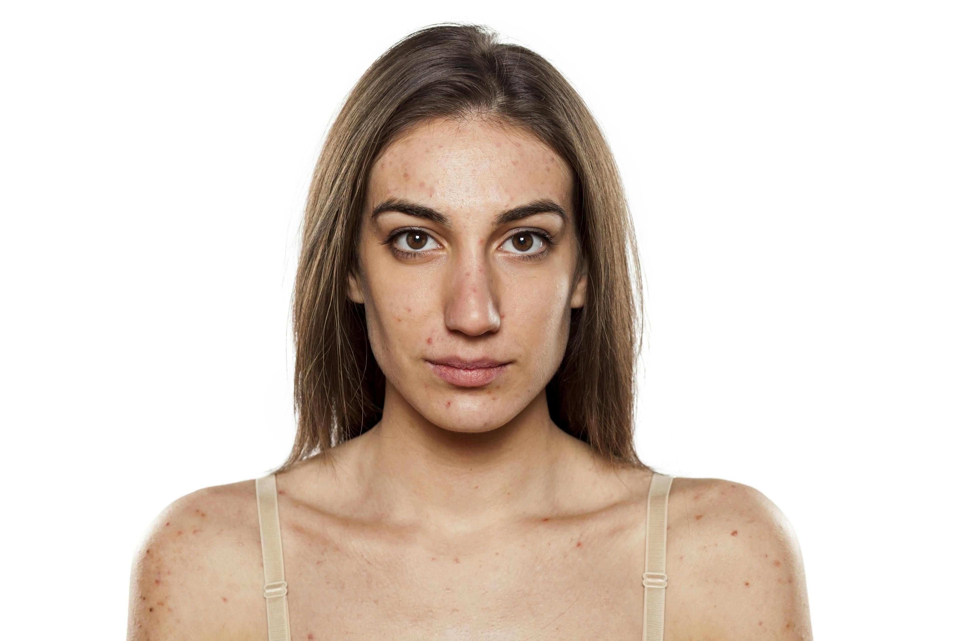How Does Acne Affect the Adult Woman?