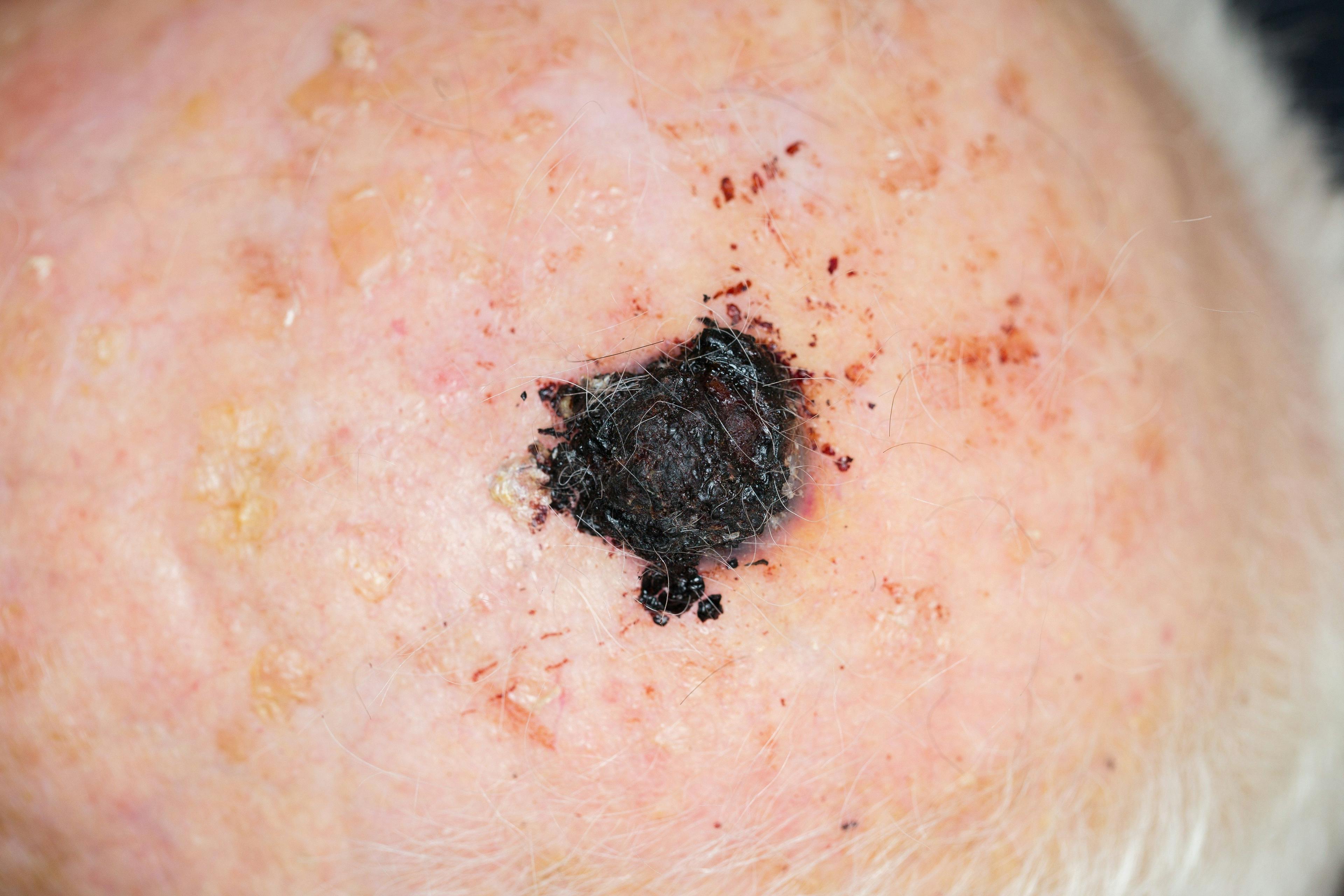 malignant melanoma on scalp