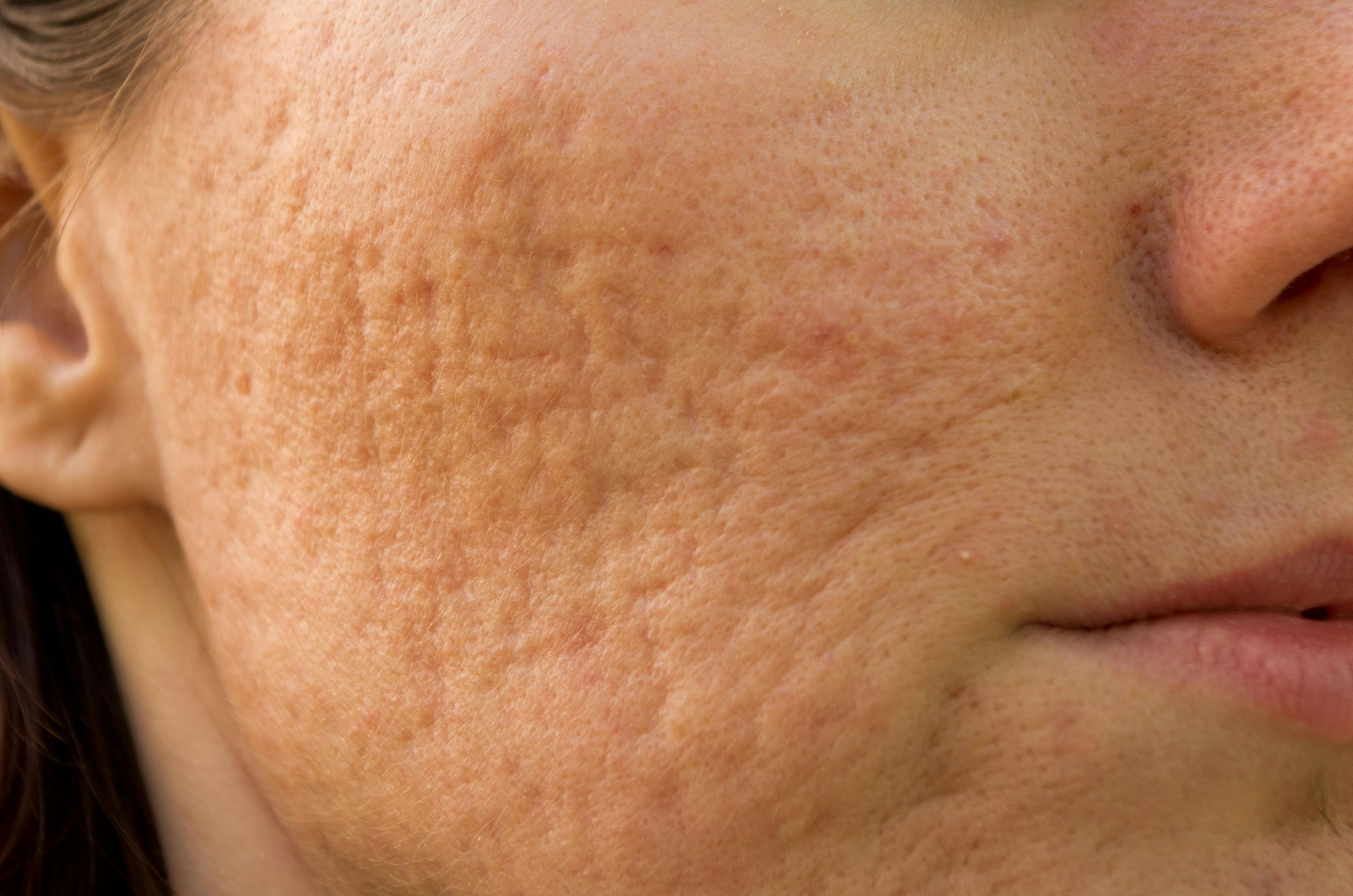 Post-Acne Vulgaris Scarring Leads to Negative Body Image and Self-Esteem