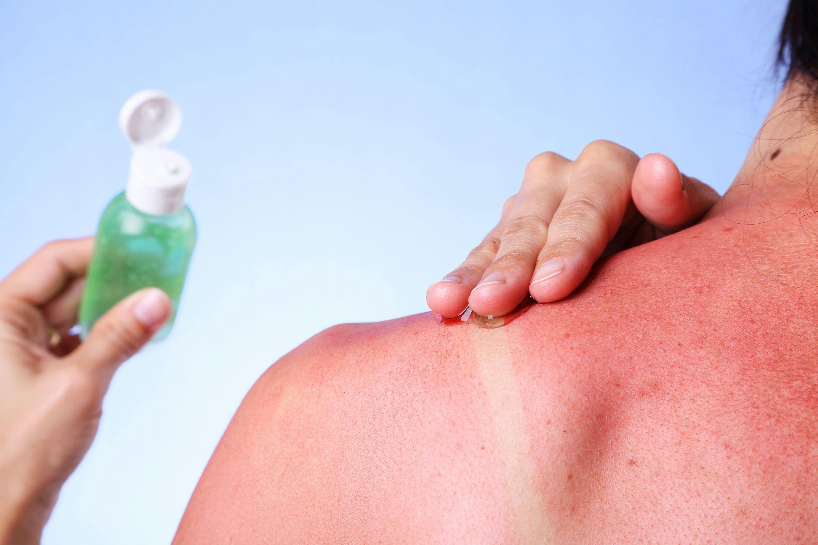 Preparing Patients for the Summer Sun: Derms Debunk 5 Sunscreen Myths