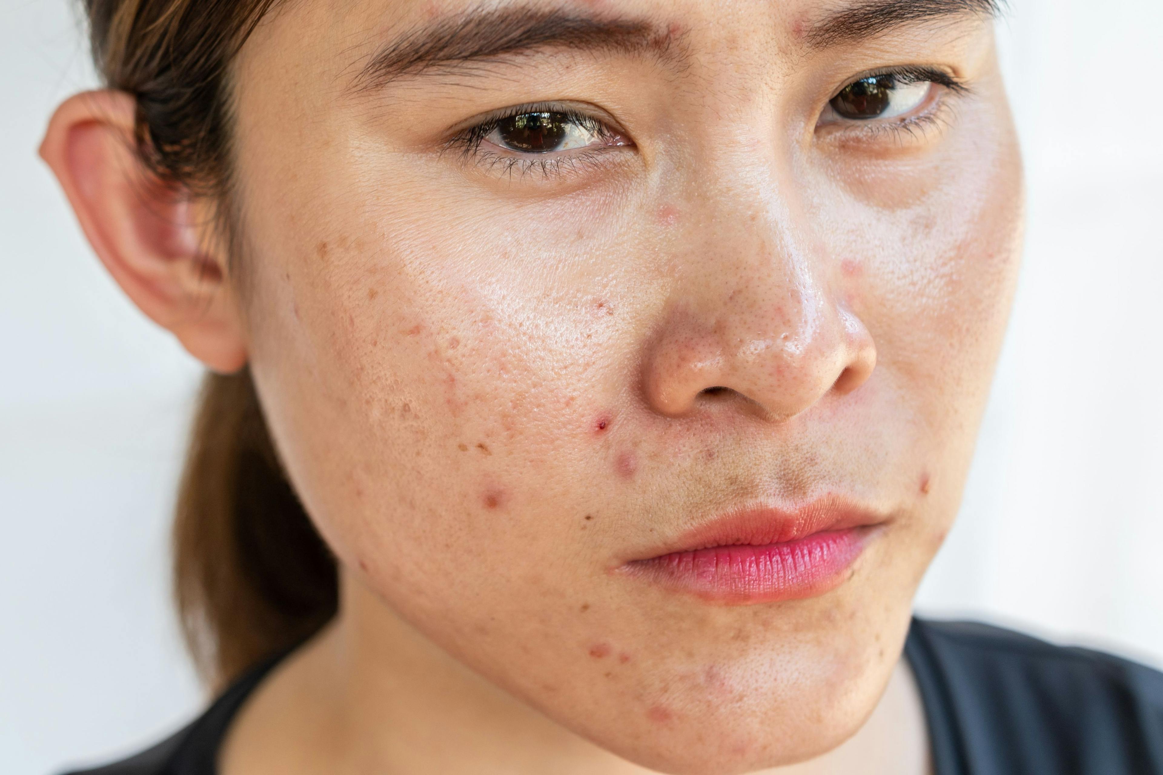Ceramide-Containing Skin Care May Improve Prescription Acne Treatment Adherence 