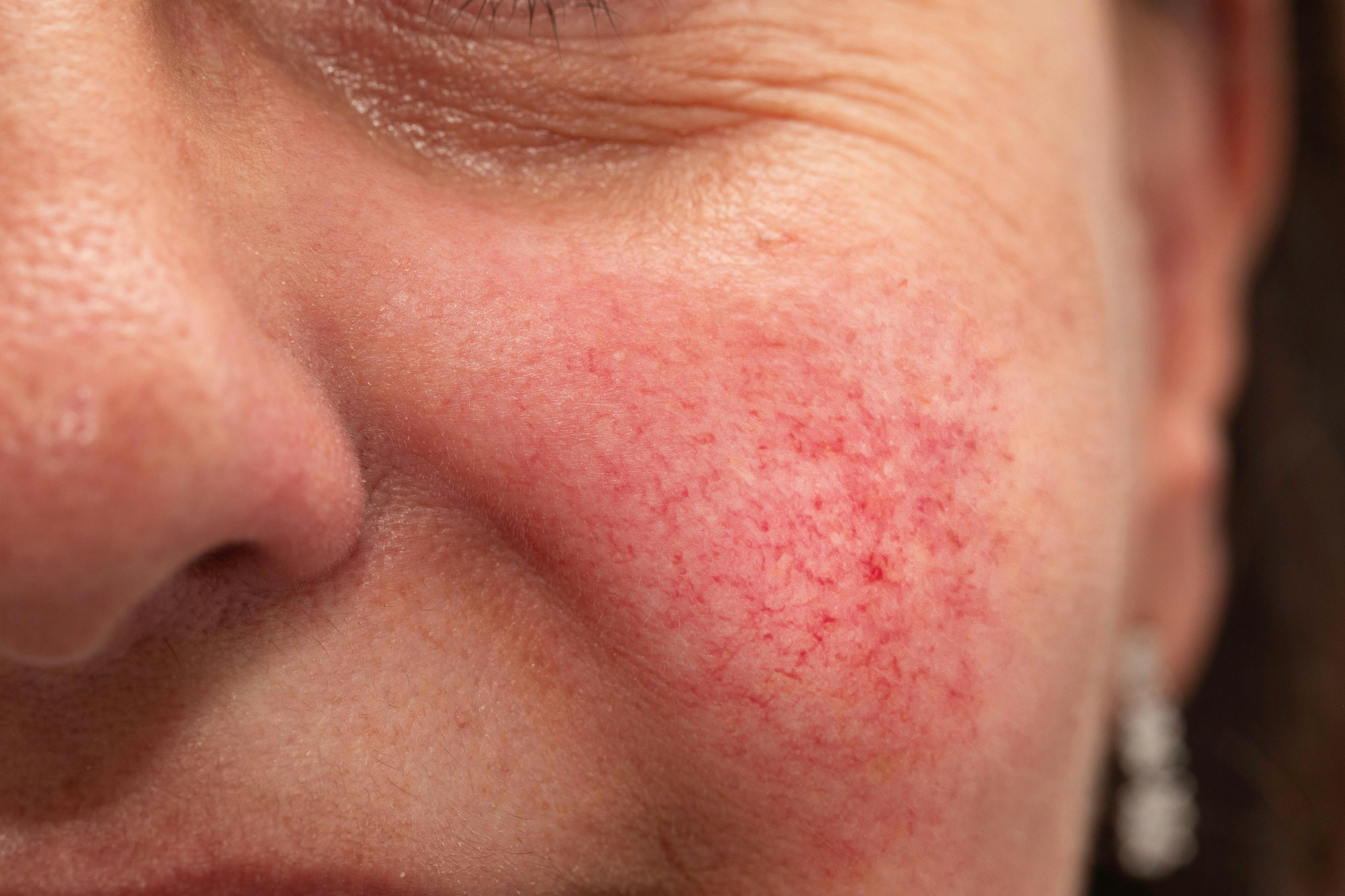 In Rosacea, Botulinum Toxin Requires Further Analysis of Long-Term Clinical Efficacy and Safety