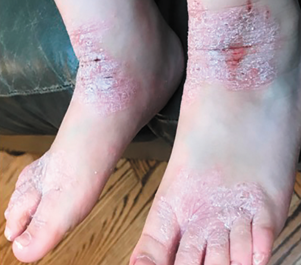 atopic dermatitis feet