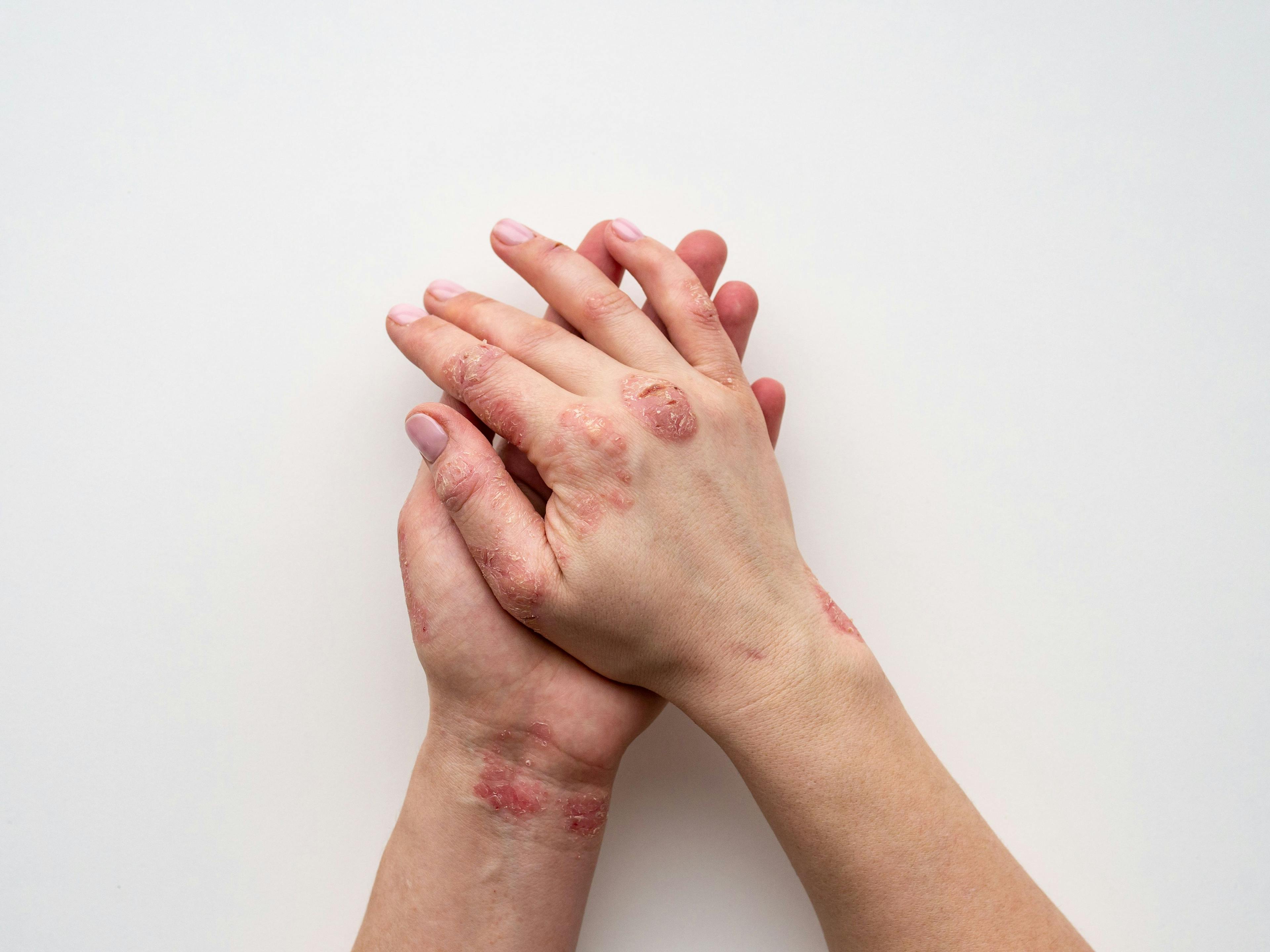 Effect of Joint Pain on Analgesic Use in Patients with Psoriasis