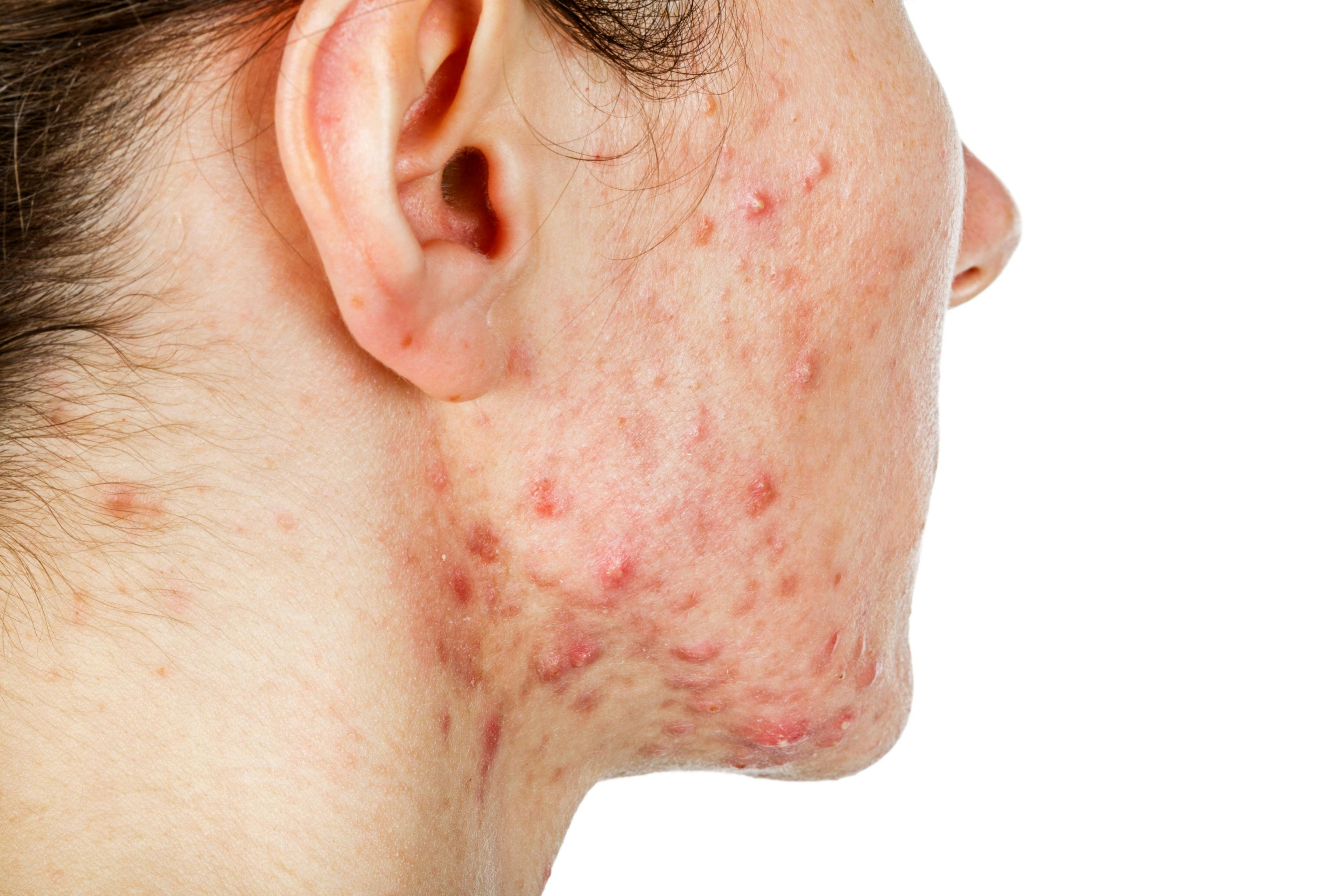 Adult woman with acne | Ocskay Bence - stock.adobe.com