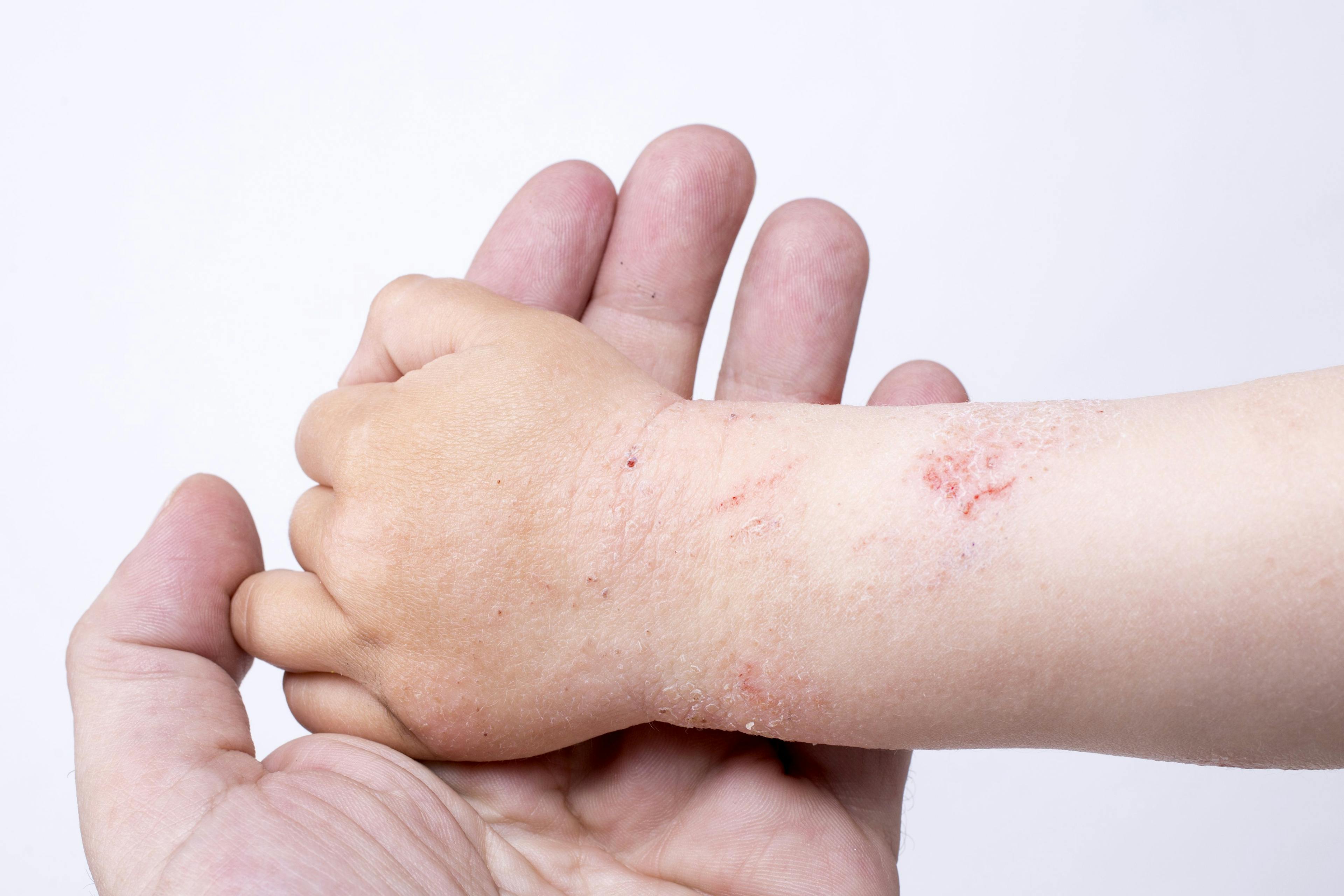 child with atopic dermatitis