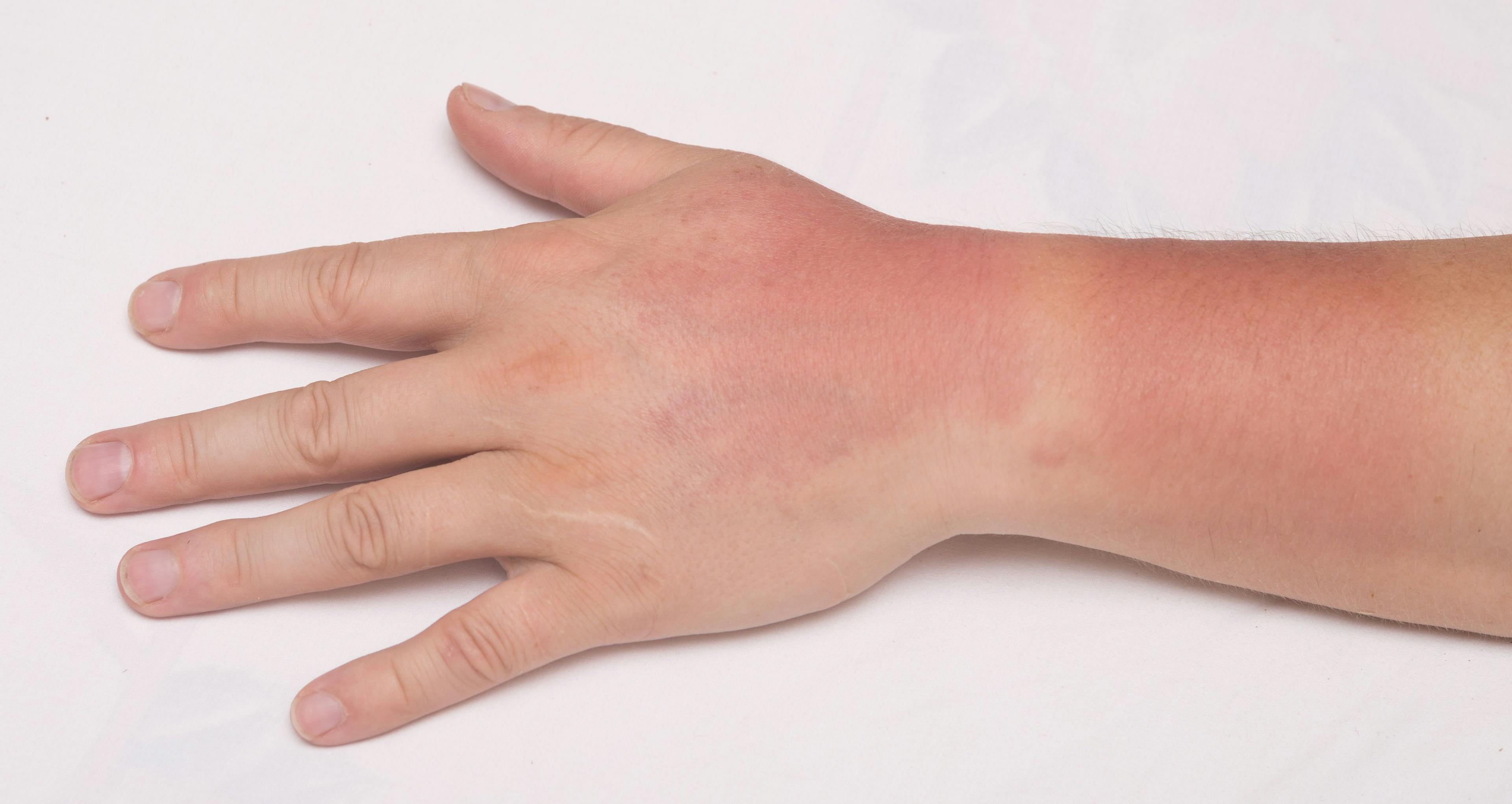 Preparing Patients for the Summer Sun: Special Issues in Photosensitivity