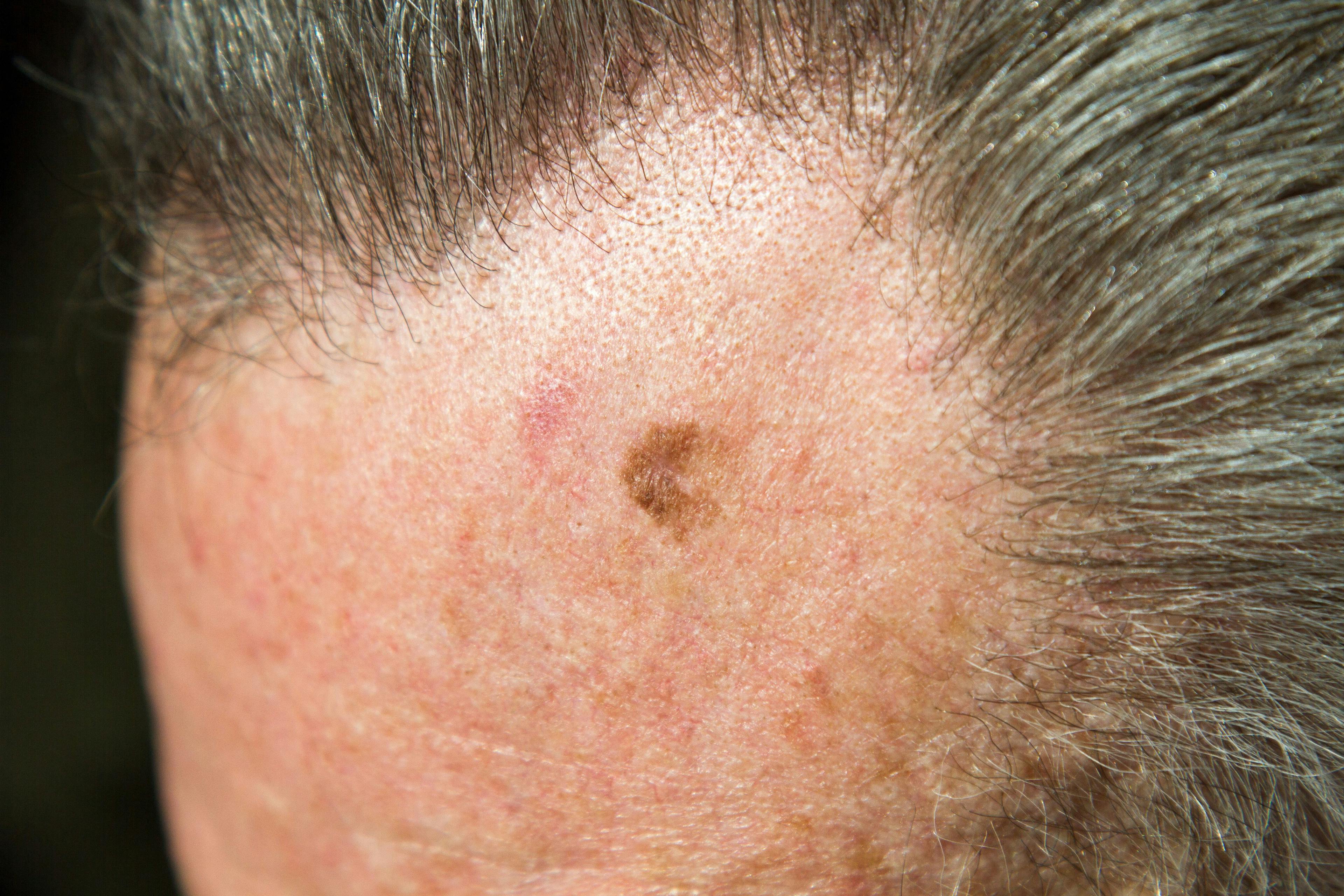Melanoma in situ on older male forehead