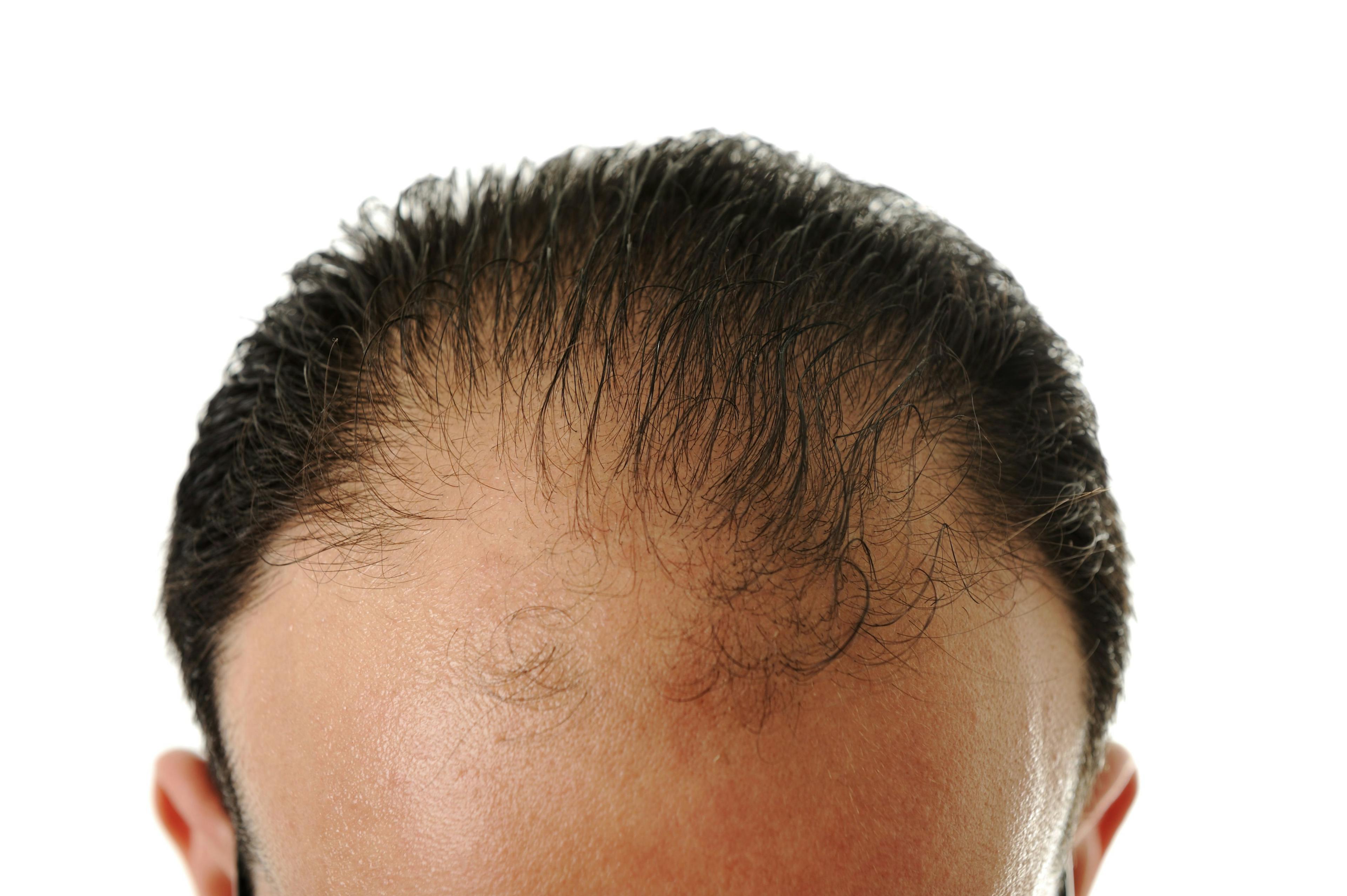 Pharmacists Play Crucial Role in Advising Patients With Androgenetic Alopecia