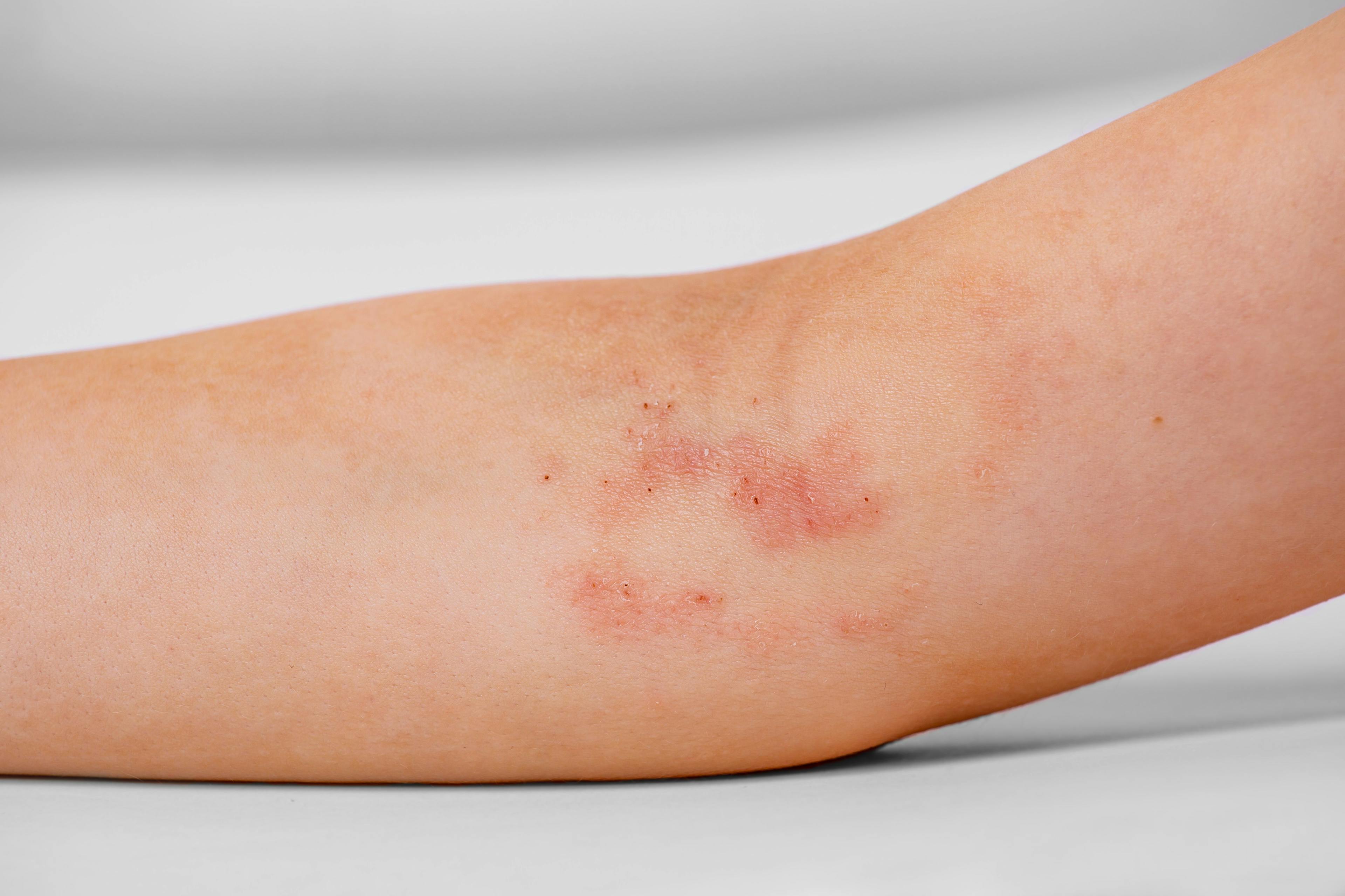 Atopic Dermatitis: A Personalized Approach May Improve Outcomes
