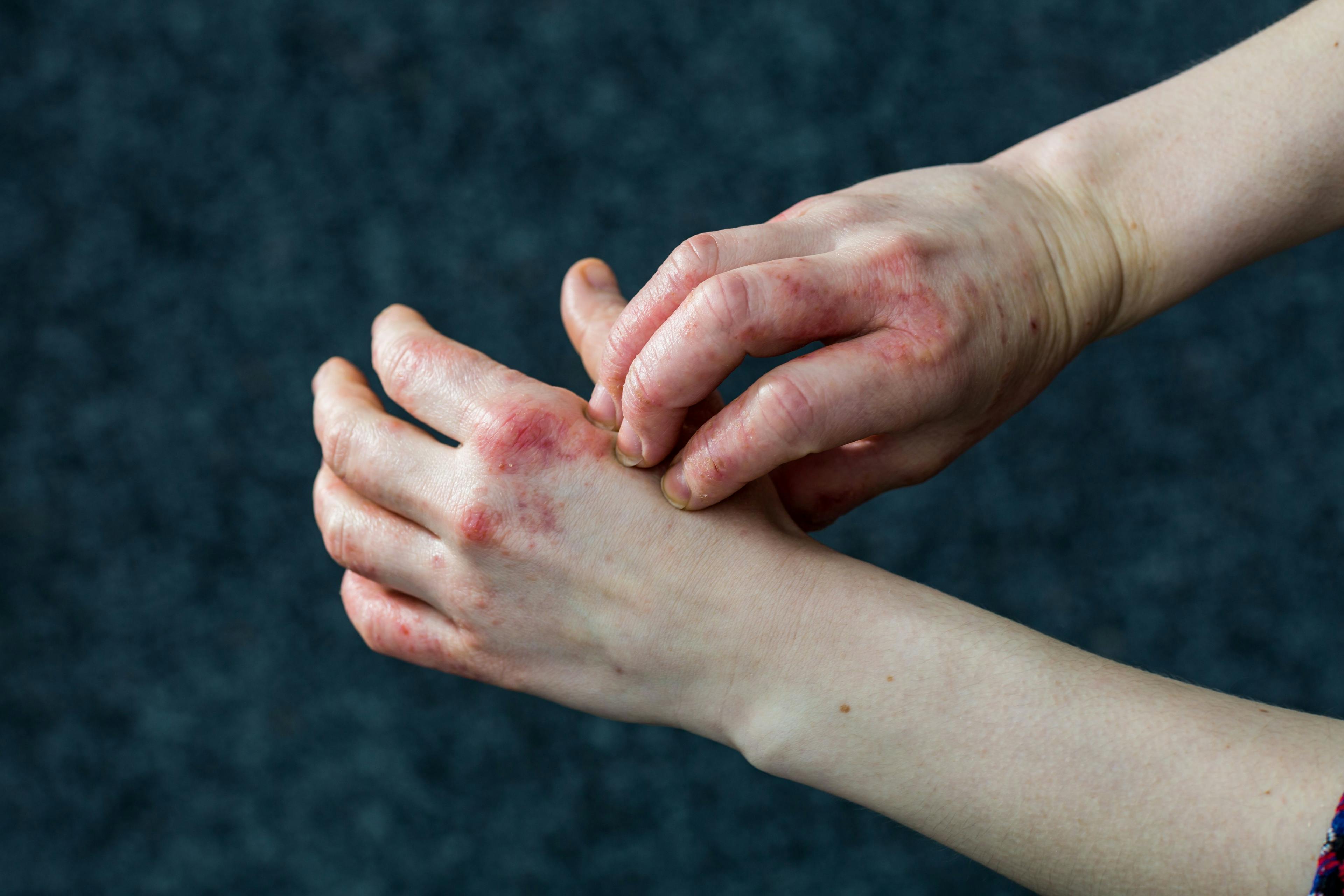 Person with eczema scratches their hands