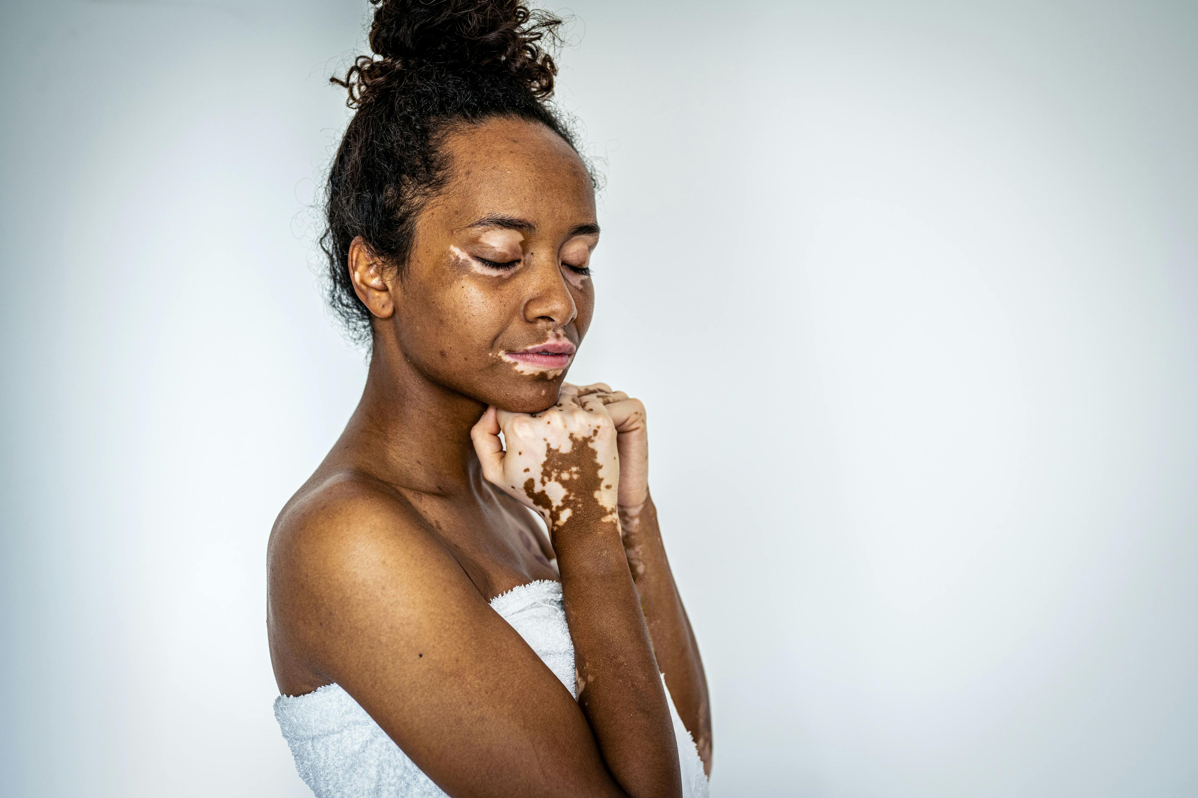 Examining Comorbidities in Vitiligo