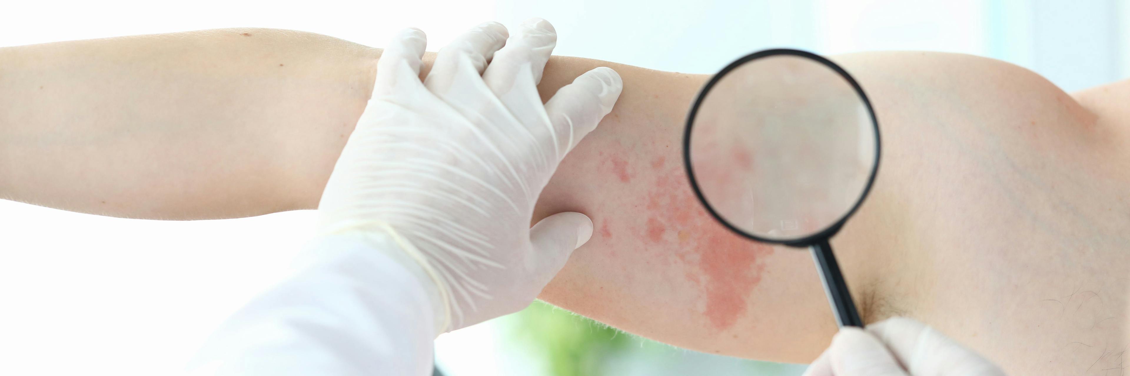 Preventing Misdiagnosis of Rare Skin Diseases