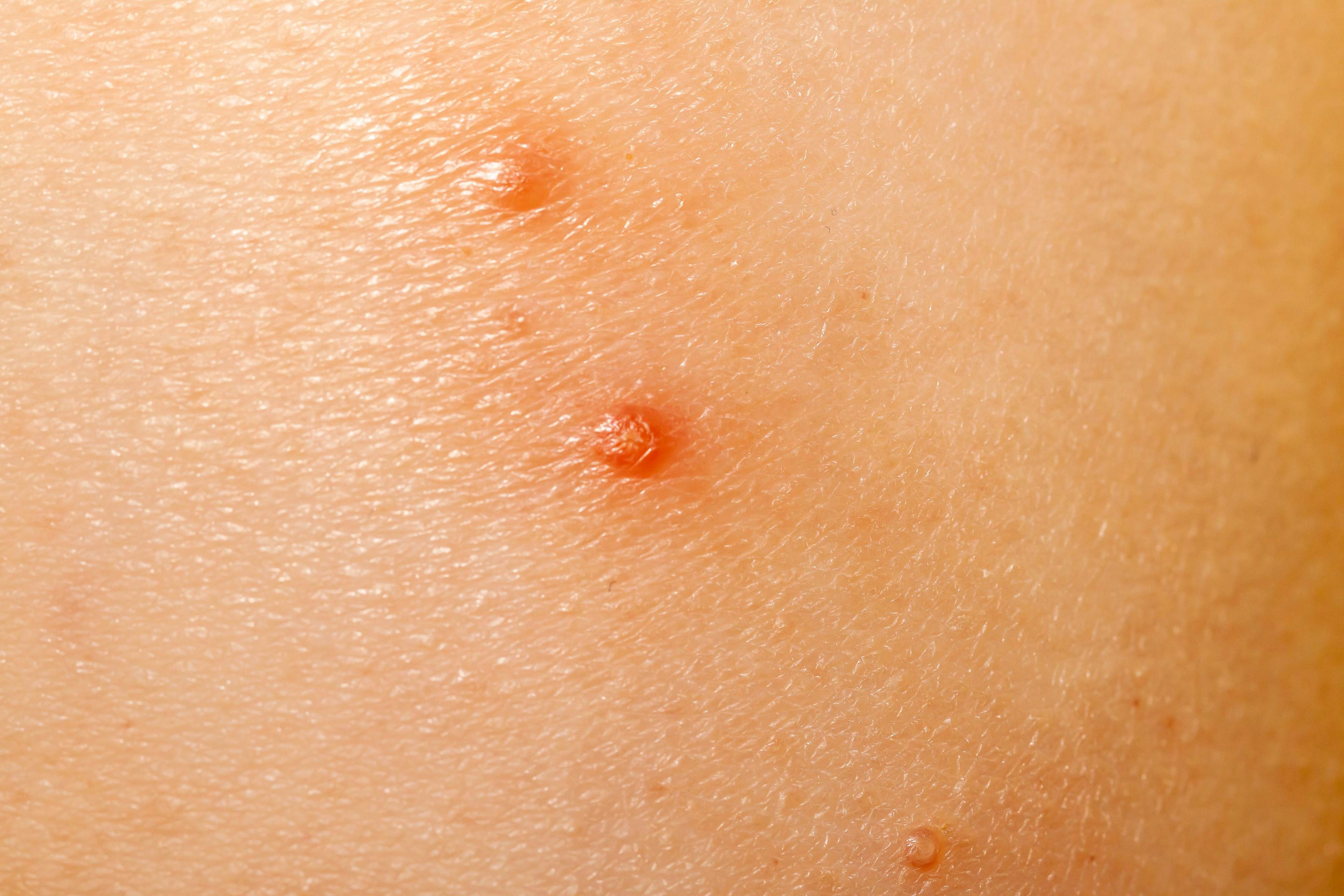 Berdamizer Gel Safe, Well-Tolerated in Patients With Molluscum Contagiosum