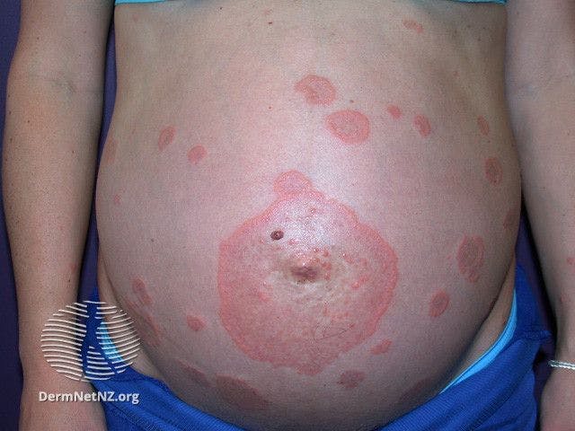 Managing Pemphigoid Gestationis in Pregnancy: Clinical Insights and Treatment Recommendations 