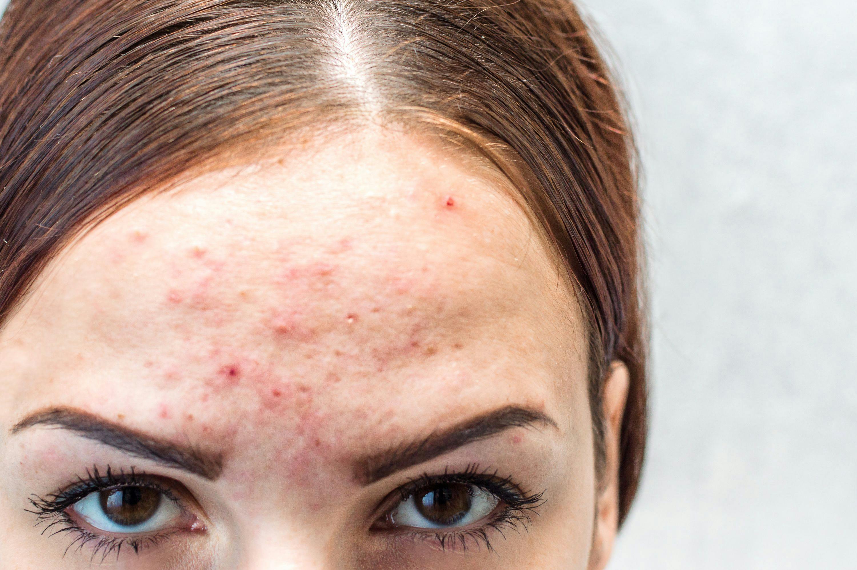 A Look at the Rise in Adult Acne in Women