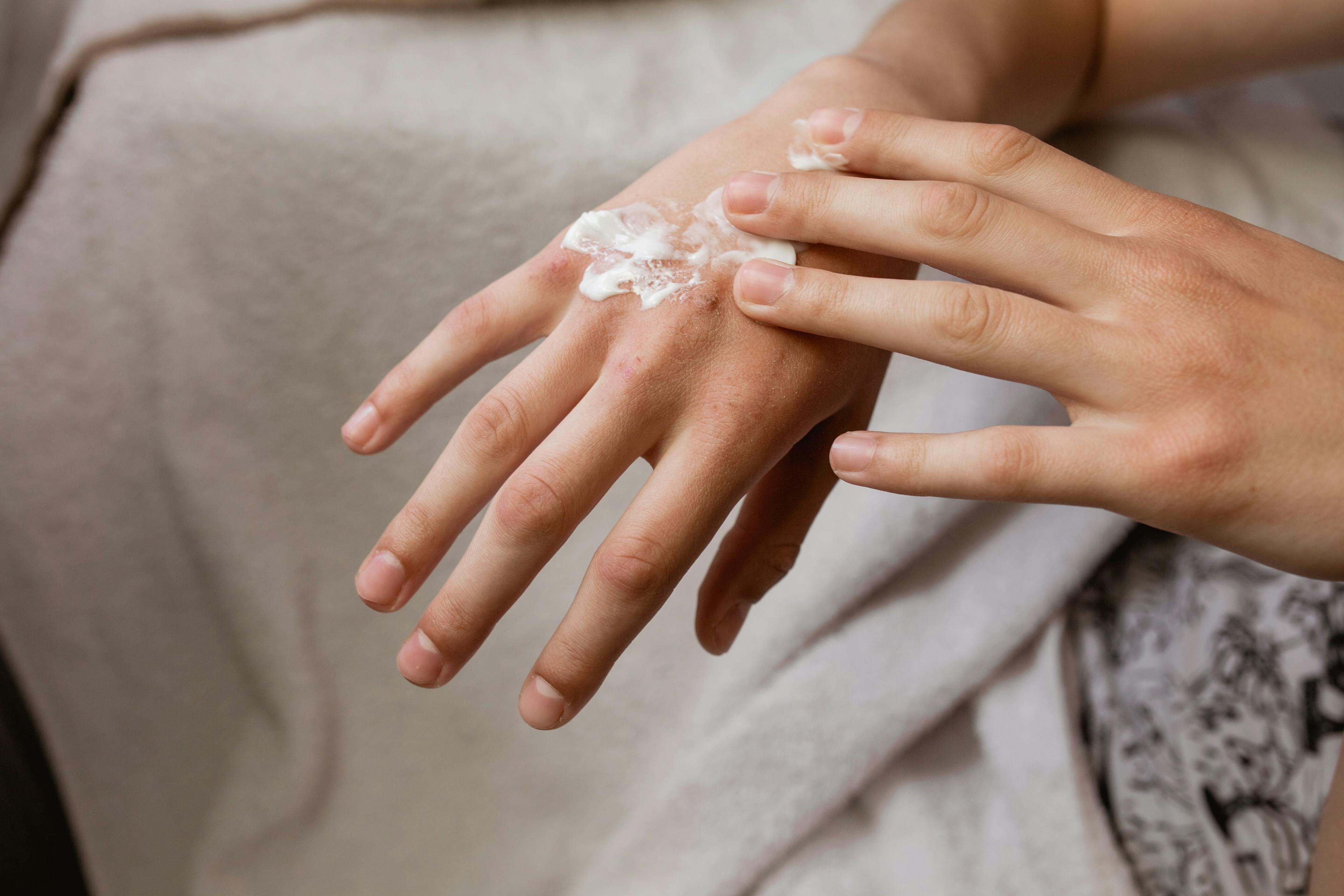 Delgocitinib Reduced Itch, Pain in Patients With Hand Eczema