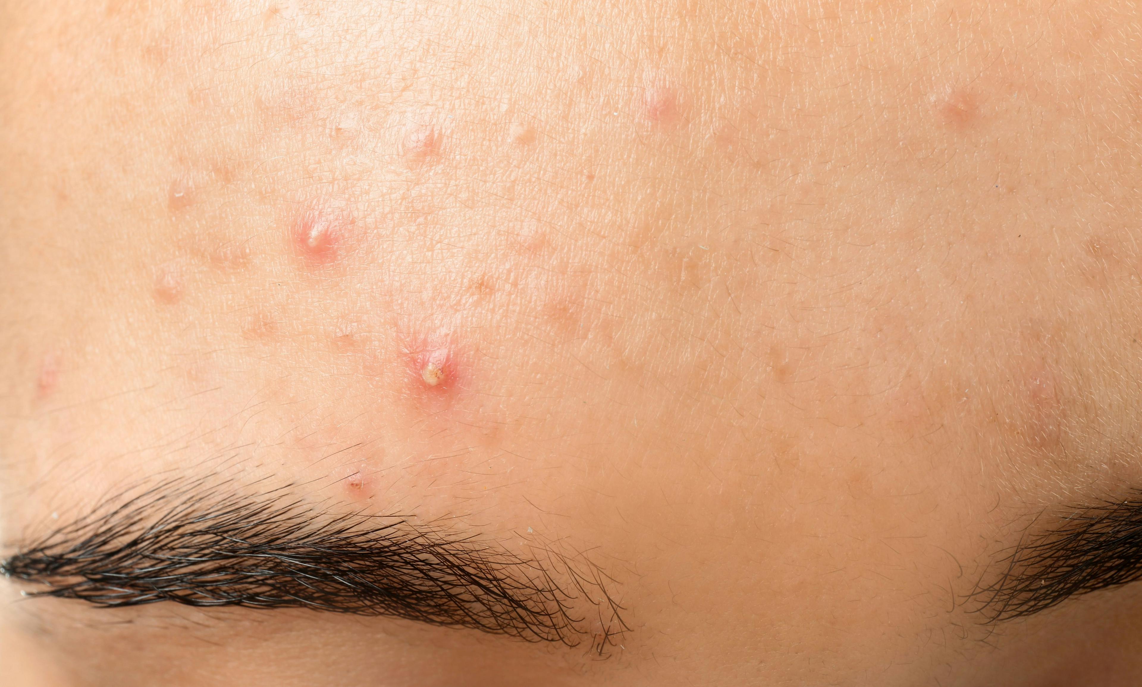IDP-126 Gel Demonstrates Superior Efficacy in Moderate-to-Severe Acne
