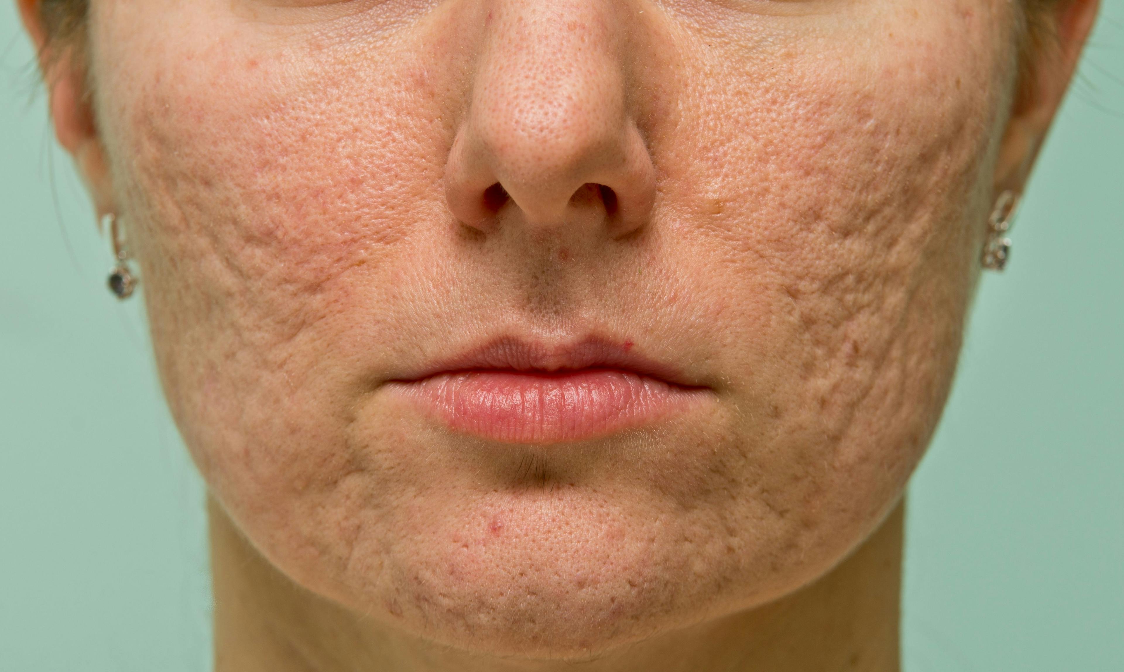 FDA Clears Sofwave SUPERB Applicator for the Treatment of Acne Scars 