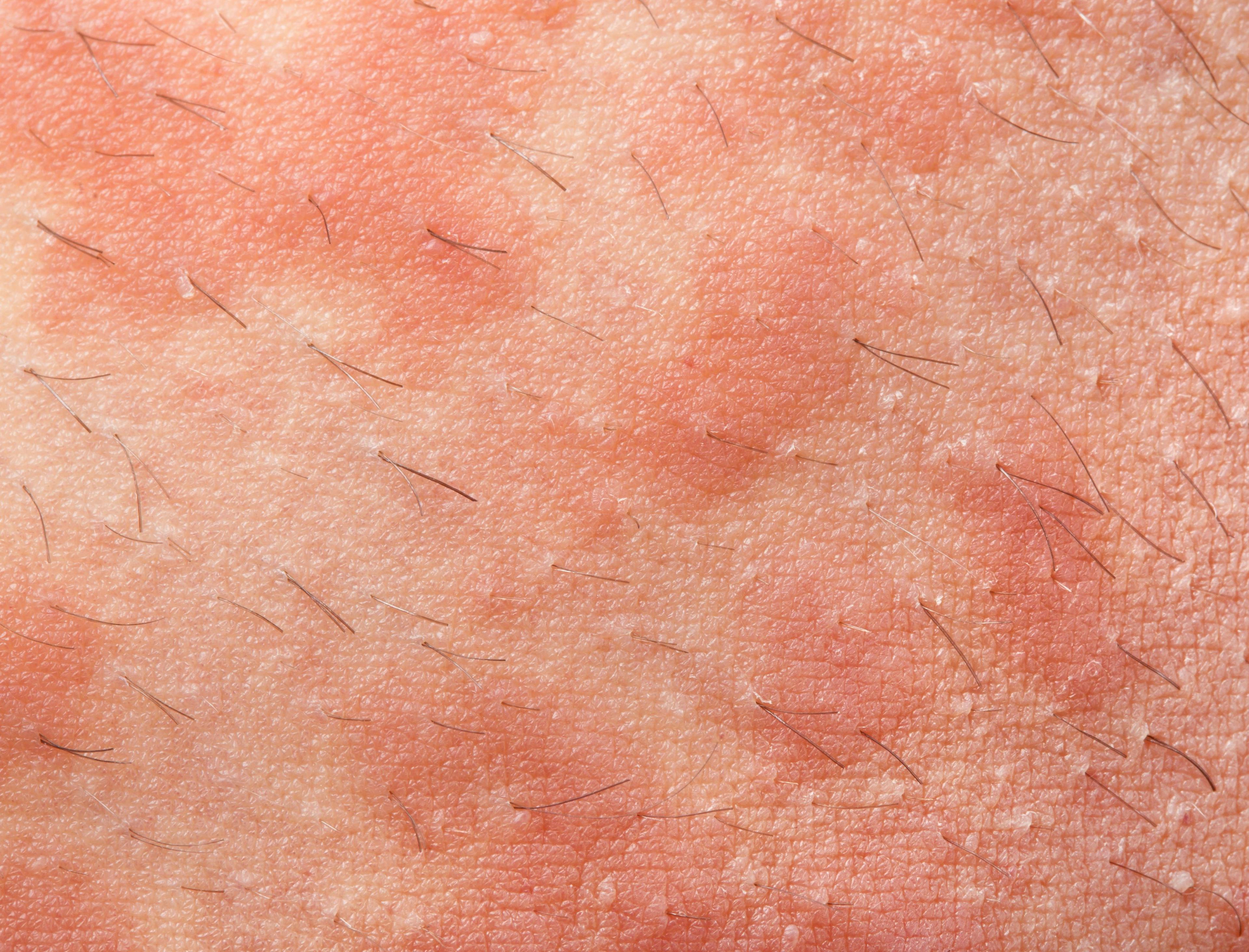 Tralokinumab with TCS Effective in Patients with Severe Atopic Dermatitis