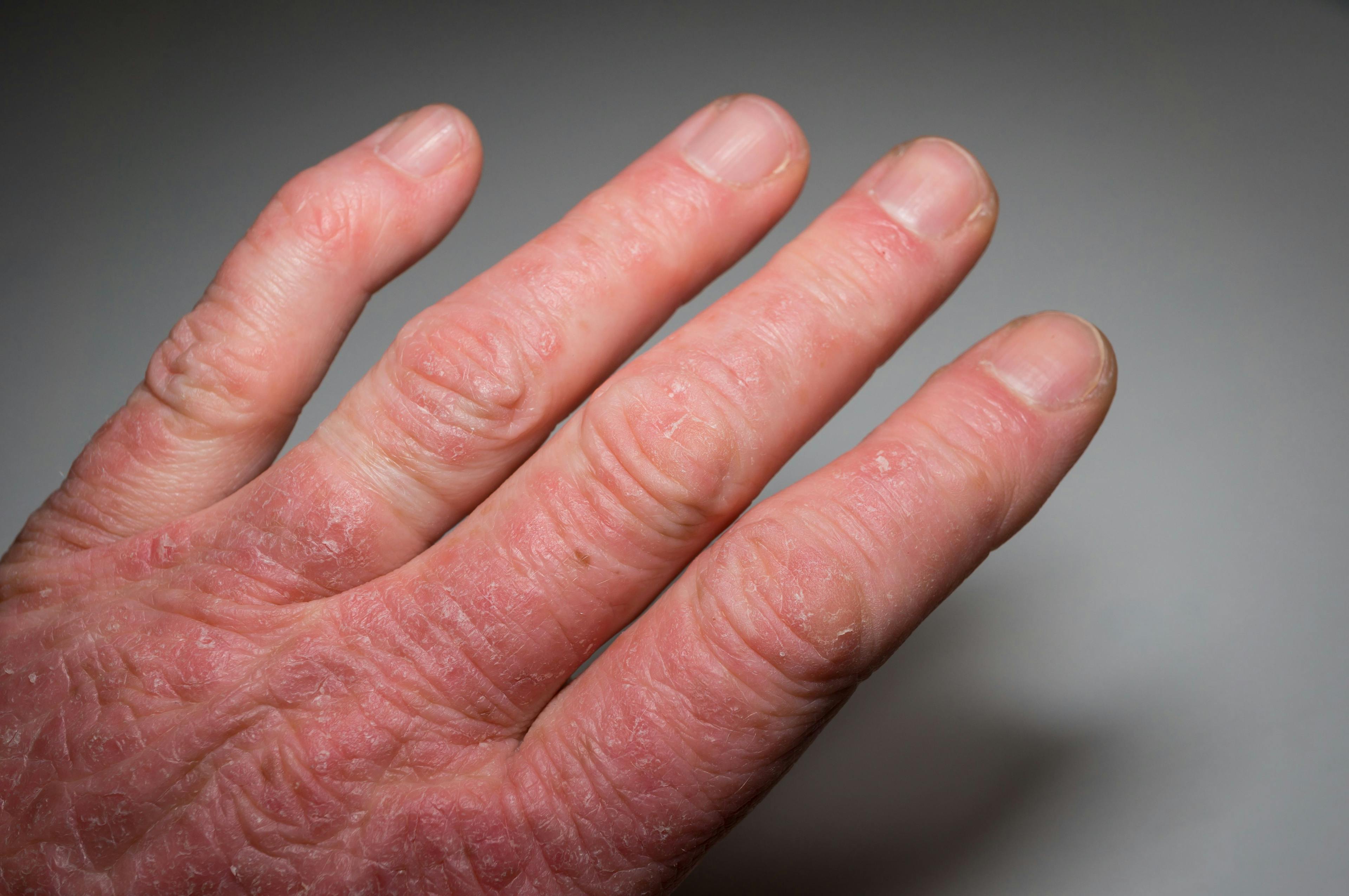 Upadacitinib Receives FDA Approval for Active Psoriatic Arthritis