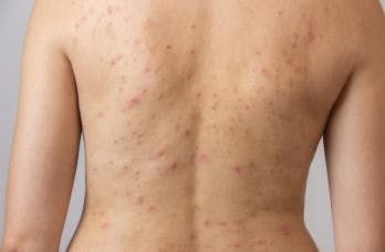 What's New in Truncal Acne?