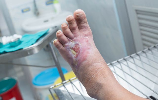 Caring for the diabetic foot