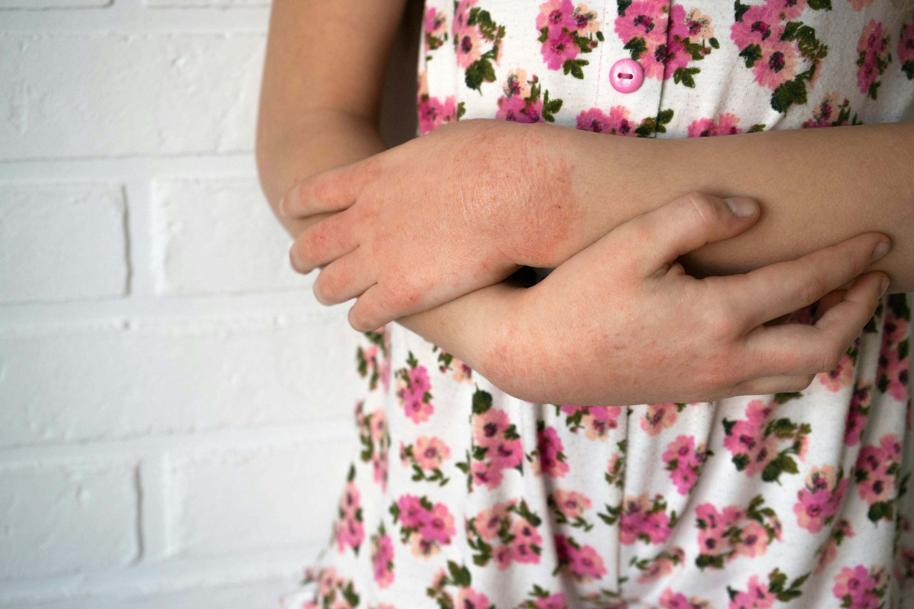 Allergic Contact Dermatitis Common Among Children Exposed to Cobalt